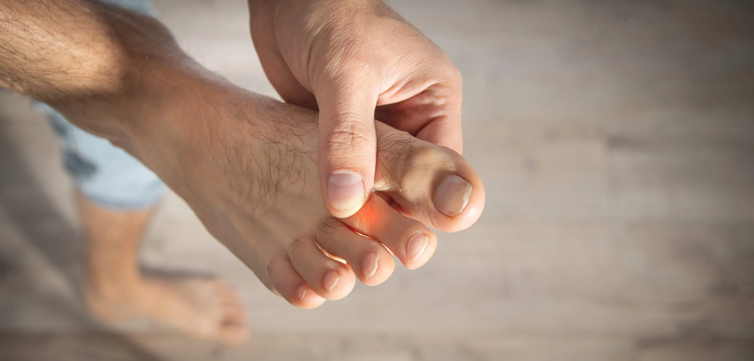 Throbbing hammertoe deformity with swollen, painful bent toe and corns — conservative care, splints, custom orthotics, footwear and surgical options at Canadian Foot Clinic & Orthotic Centre St. Catharines ON.