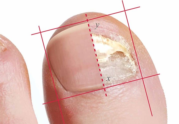 Fungal toenail infections showing thickened, discolored nails — onychomycosis assessment and treatment, antifungal care, Lunula laser therapy, nail debridement by registered chiropodist Canadian Foot Clinic & Orthotic Centre, St. Catharines.