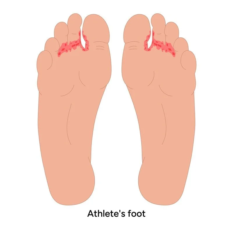 Illustrated athlete's foot between toes: red, scaly interdigital rash with burning and itching; antifungal treatment, toe care, footwear advice and prevention by registered chiropodist Canadian Foot Clinic & Orthotic Centre, St. Catharines.