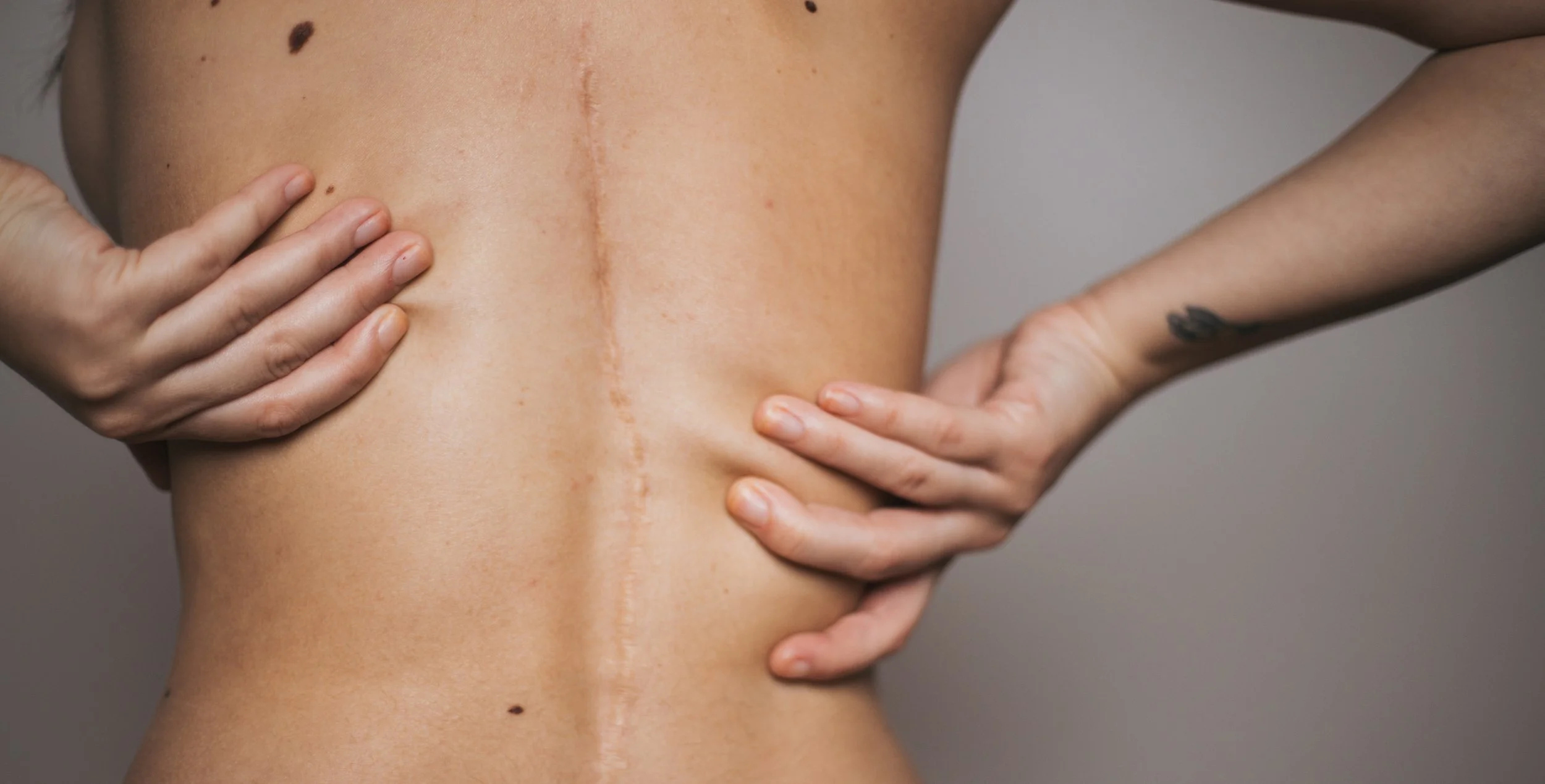 A person with a visible surgical scar running down the middle of the back, with hands resting on the sides of the torso.