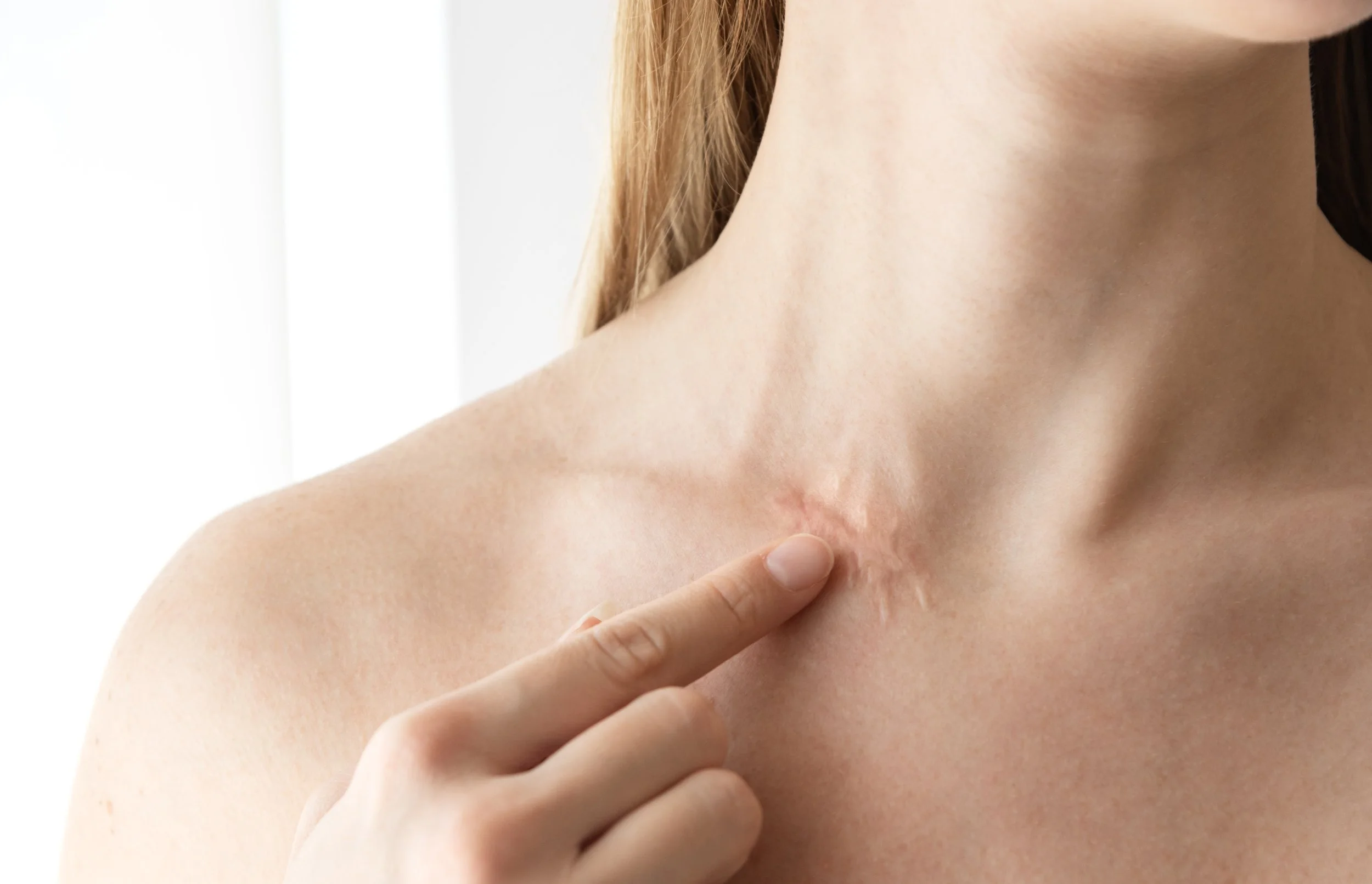 Close-up of a woman's shoulder and neck showing a scar. A finger is pointing to the scar.