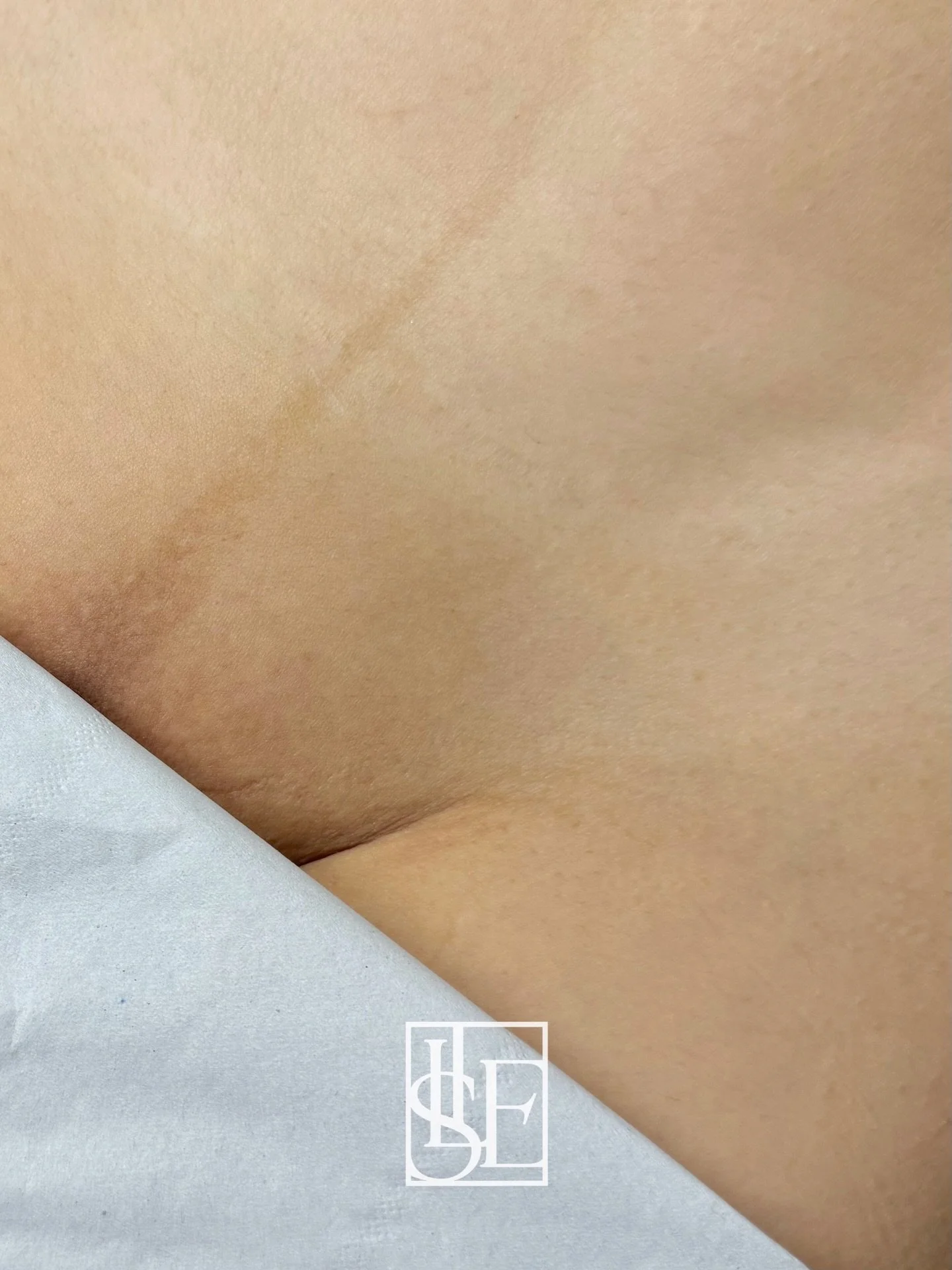 Hollywood + bikini line results that speak for themselves.

💗 Around 8&ndash;10 sessions are usually needed
 ⏰ Treatments are spaced every 6 weeks to start
 🌸 Booking link is in our bio 
 💌 Please send us a message if you have any questions