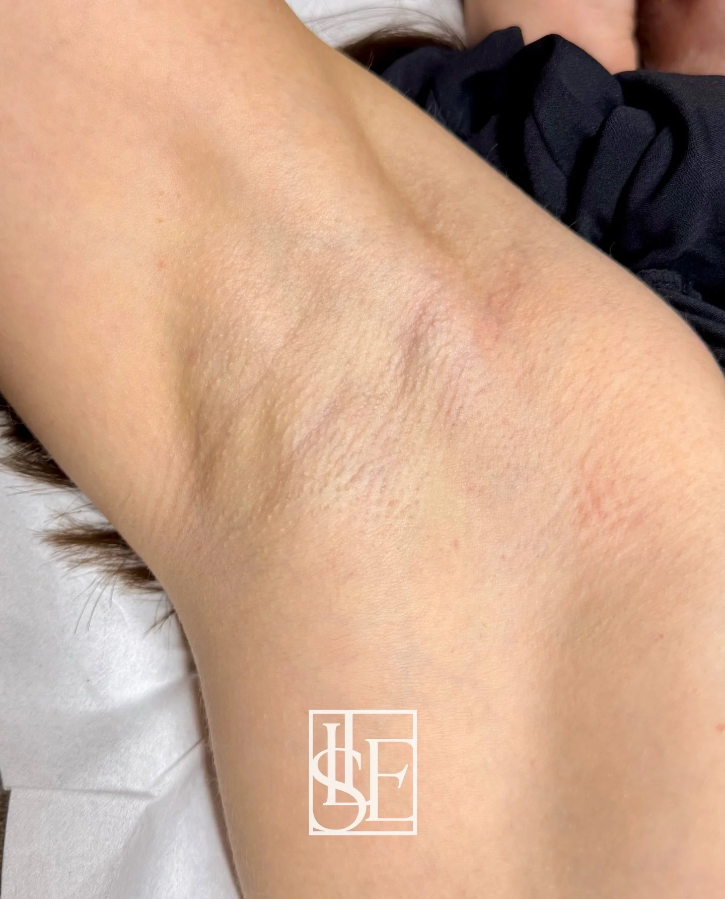 Smooth, soft, shadow-free underarms? We&rsquo;ve got you. 🤭

💗 Around 8&ndash;10 sessions are usually needed
 ⏰ Treatments are spaced every 6 weeks to start
 🌸 Booking link is in our bio 
 💌 Please send us a message if you have any questions