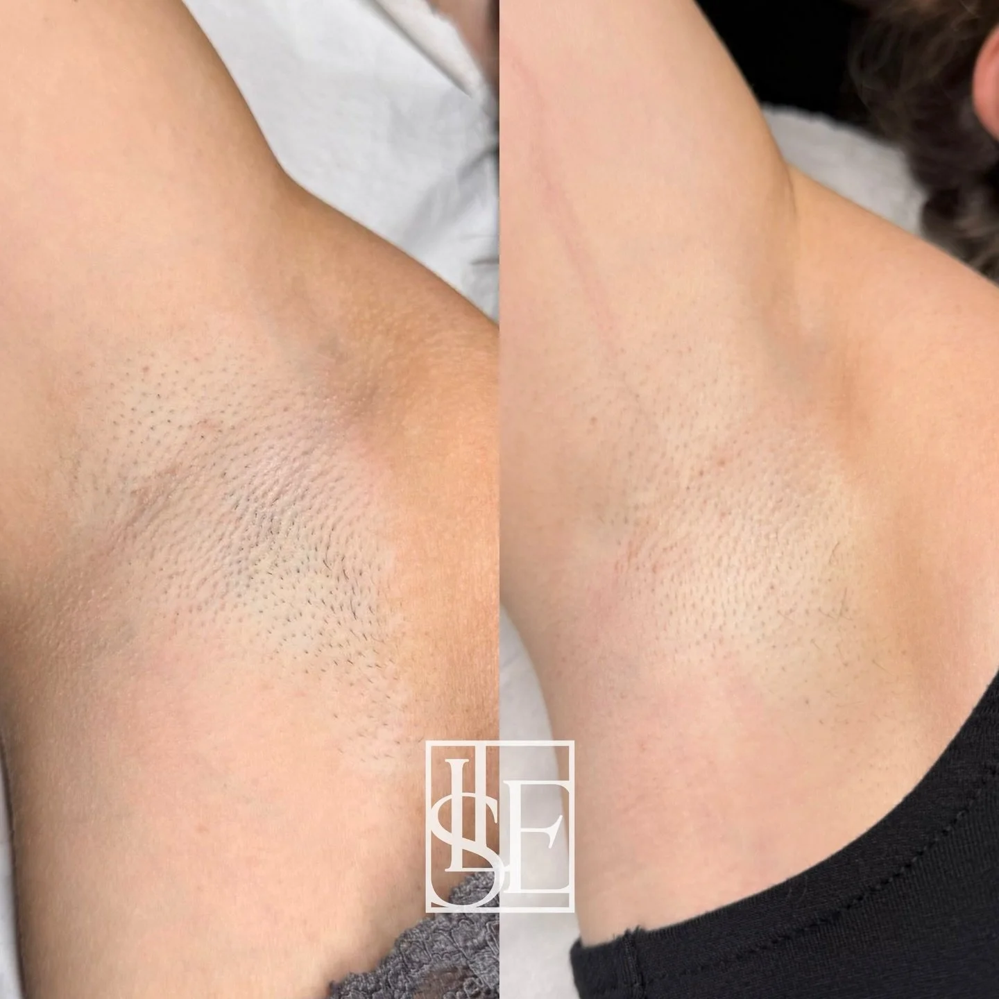 Underarm results after just one session 🤭 Laser really is that amazing ☺️✨