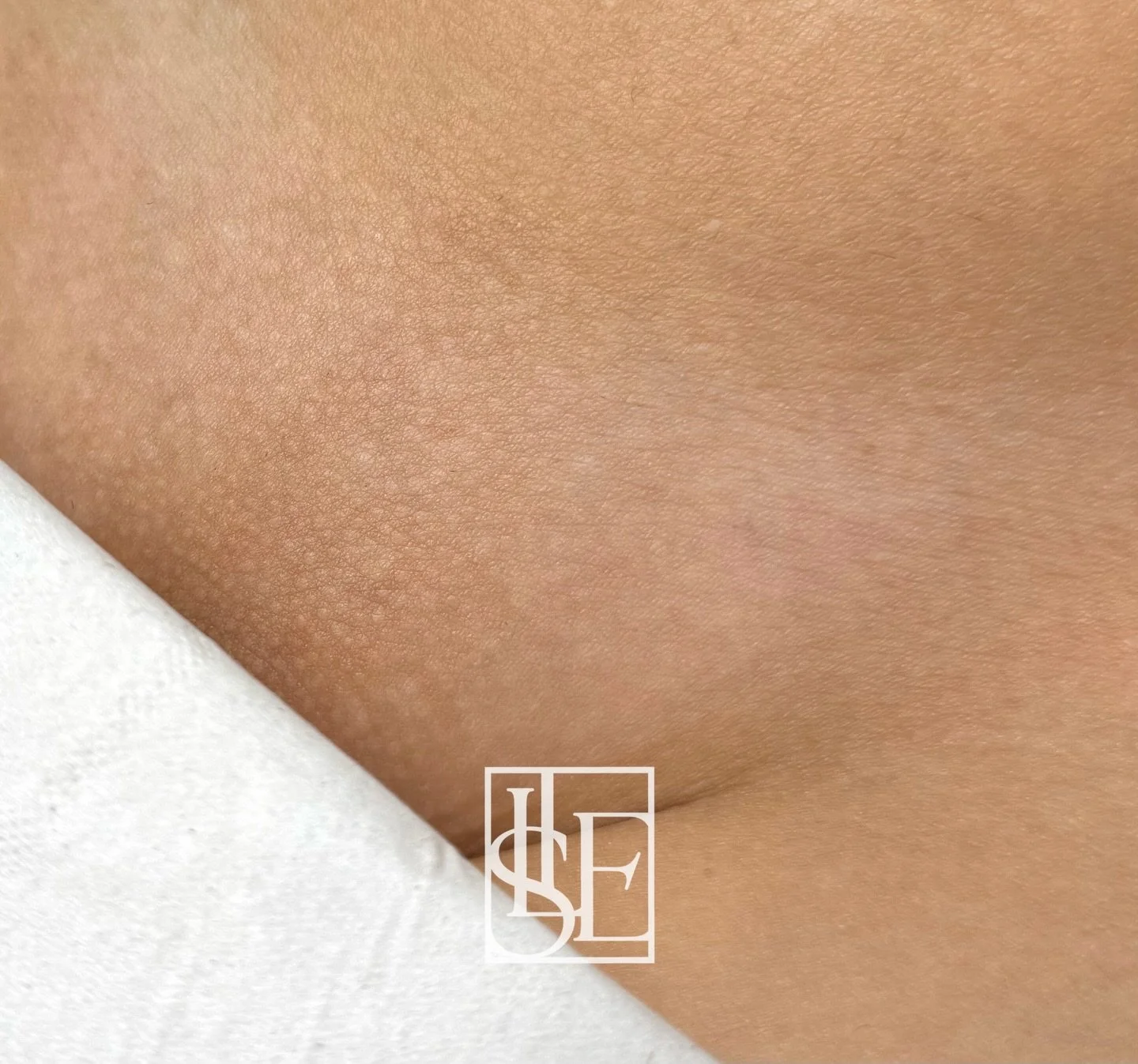 Hollywood Laser Hair Removal &mdash; smooth, hair-free skin with an even texture. 👏 👏 

#oxfordshirelaser 
#cotswoldlaserhairremoval 
#laserhairremovaloxford