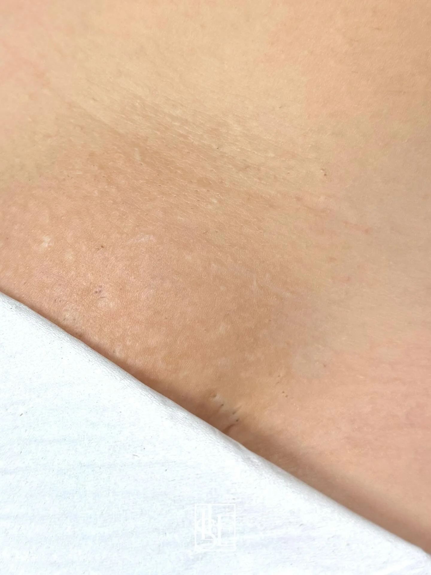 This is why we love a good maintenance session ✨

Swipe ➡️ to see the journey from the very beginning
📸 Top: before any laser treatment
📸 Bottom: after a full course &mdash; 18+ months later, just in for maintenance

Long-term results > quick fi