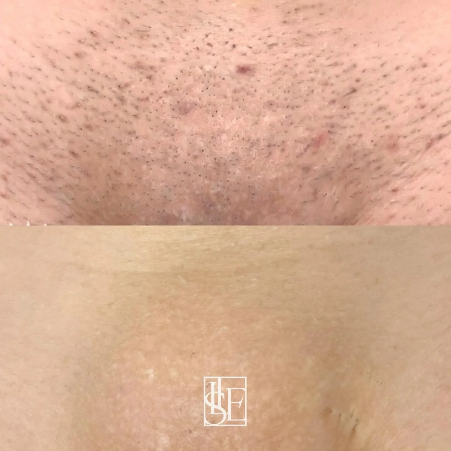 🤯 LOOK at that difference!!

These are the results after a full laser course on my lovely client &mdash; smooth skin, no irritation, and confidence through the roof ✨

If you&rsquo;re dealing with ingrowns, constant irritation, or scarring, this is 