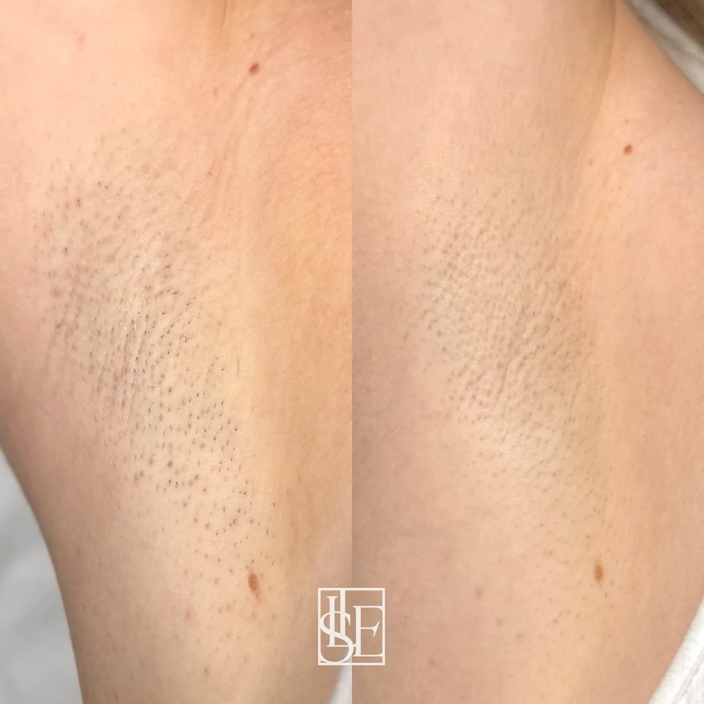 Client results after a few treatments&hellip; this is just the start of her laser hair removal journey. Can you imagine her results after a full course? 🤭 

#laserhairremovaltreatment #laserclinic #oxfordshire #banbury #beautyclinic
