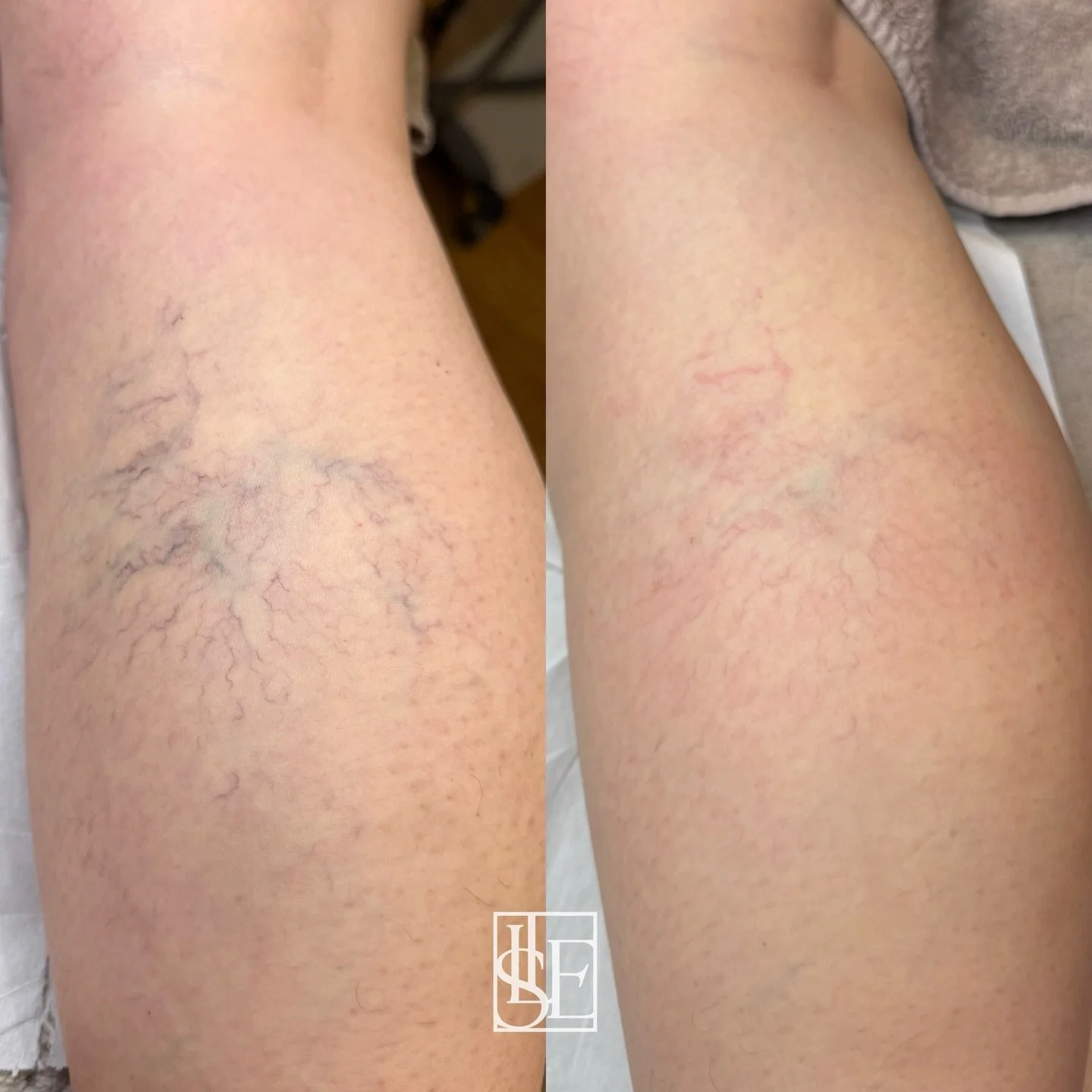Want smoother, clearer legs before summer?

These results are after TWO treatments 🥹

Our client had this cluster of spider veins for 19 years. This year, she decided she was done hiding her legs.

Pretty amazing for just two sessions?

💌 Booking l