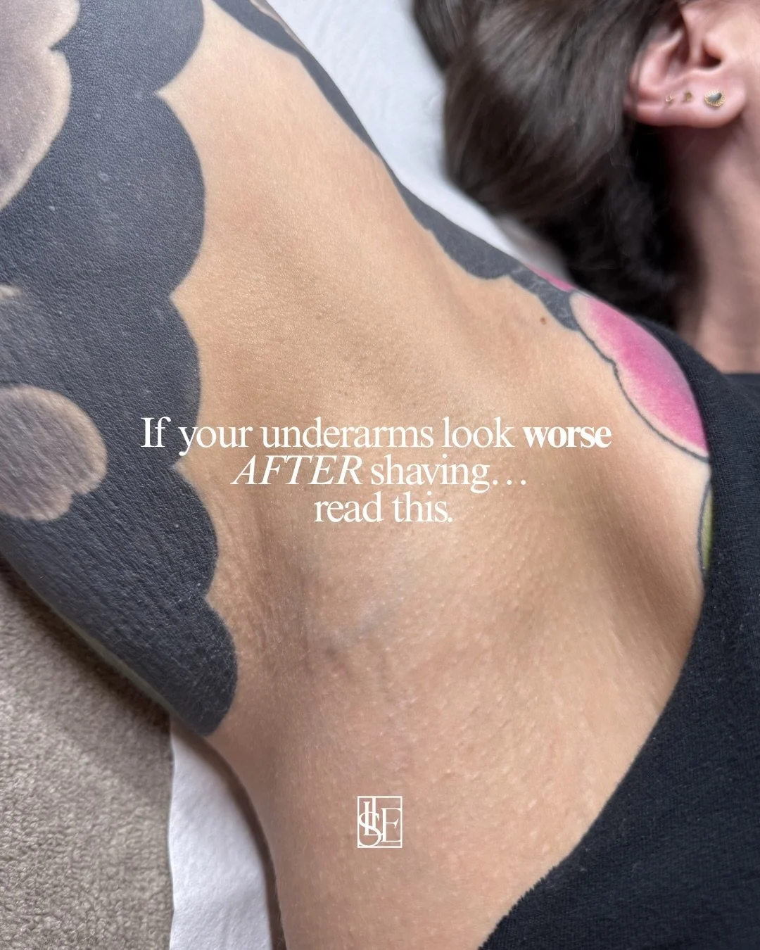 If you&rsquo;re constantly dealing with irritation, bumps or redness after shaving&hellip;

It doesn&rsquo;t have to be like that.

These results are after just ONE treatment &mdash; imagine what consistent treatments could do 👀

If you&rsquo;d like