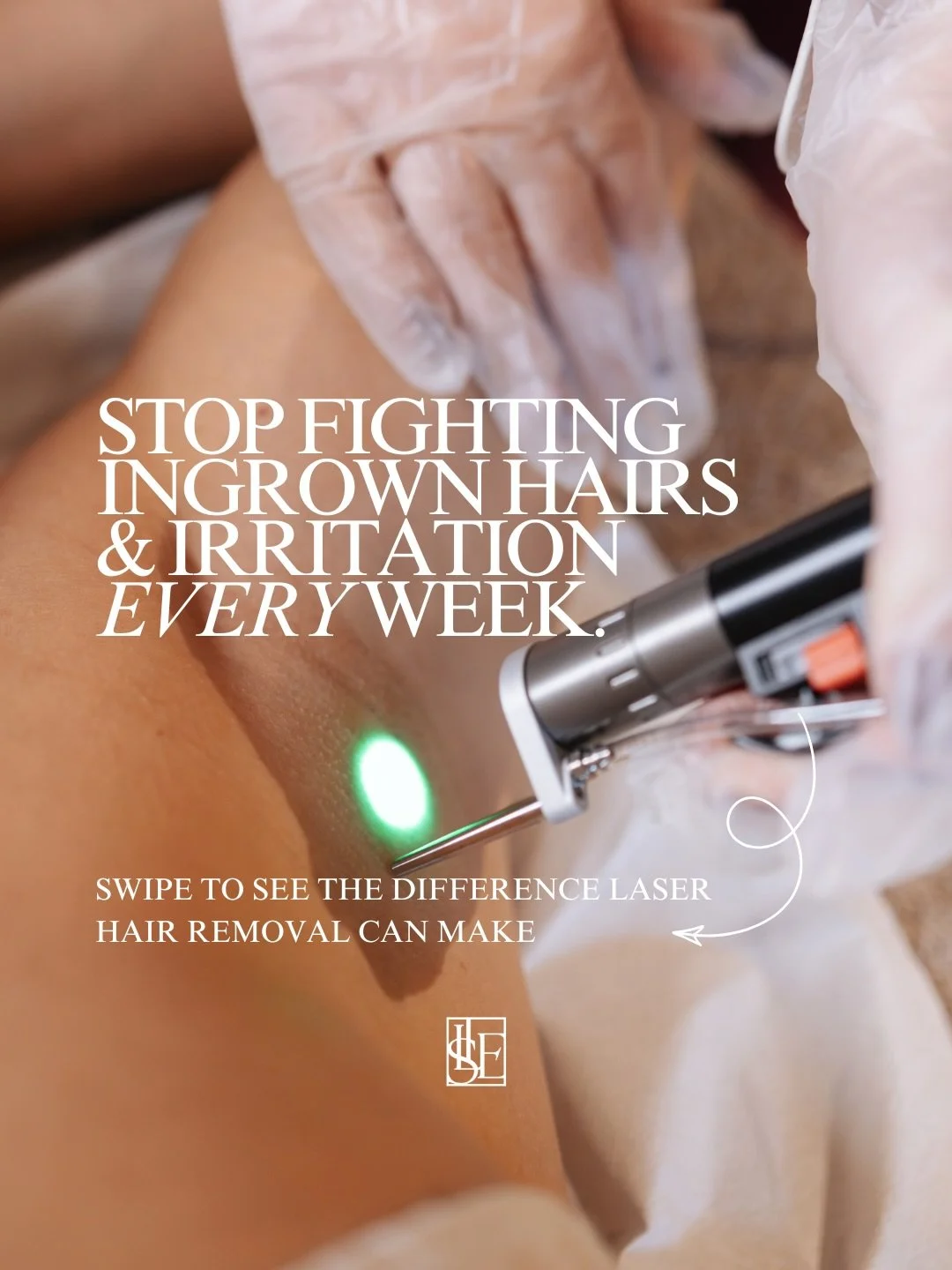 Fed up of dealing with ingrown hairs &amp; irritation after shaving or waxing? This post is for you 👀 

#laserhairremoval #laserhairresults #irritatedskin #ingrownhairs #oxfordshire