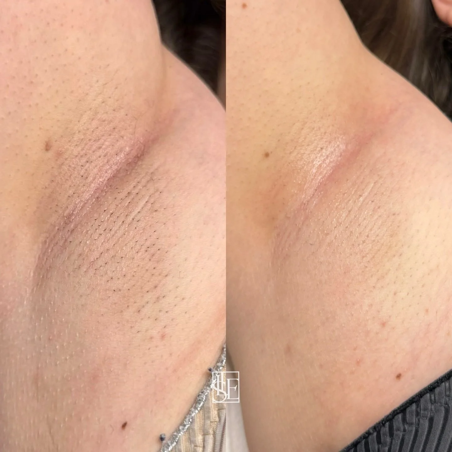 Just one session and the hair has already got the memo. 👋😂
Imagine what a full course looks like&hellip;

Link is in our bio to book your consultation. 🤍

#laserhairremoval #oxfordshireclinic #beautyoxfordshire #laserresults #cotswolds