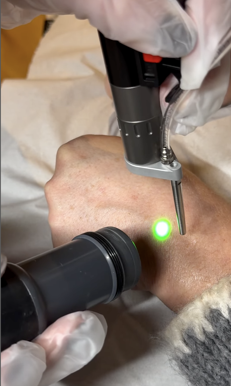 Vascular and pigmentation laser treatment using Nd:YAG technology