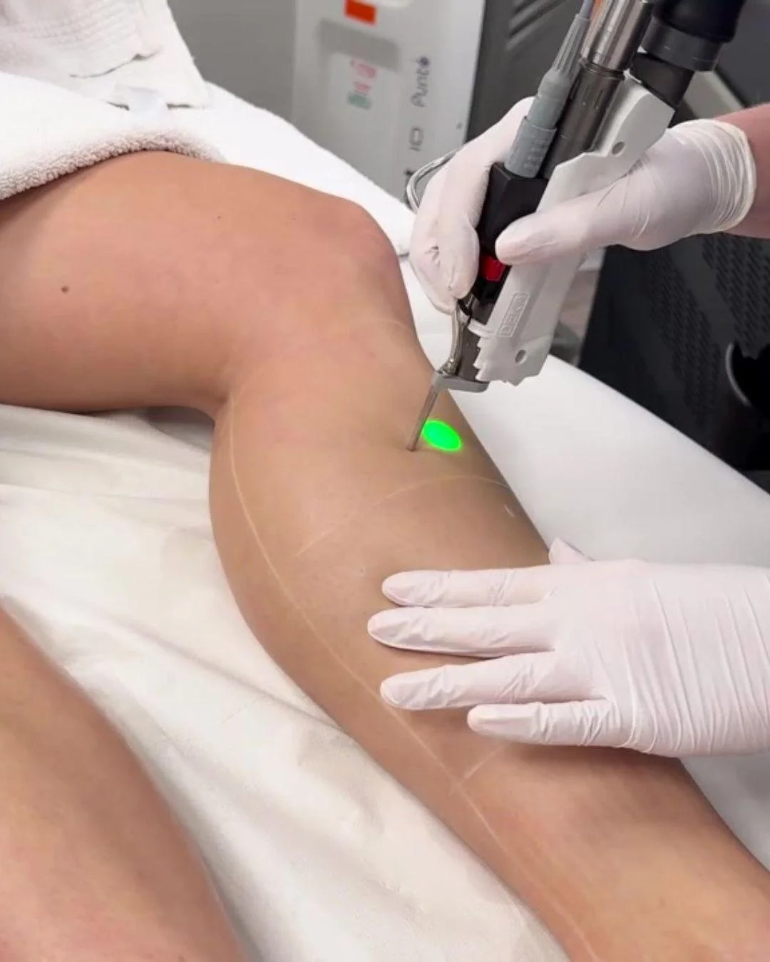 A person receiving a medical procedure on their knee using a laser device, with healthcare professional wearing gloves.