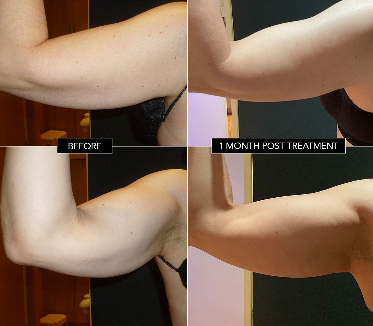 Comparison of arm muscle before and one month after treatment, showing increased muscle tone and definition.