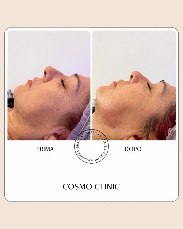 😍Risultati visibili.
Pelle tonica, contorni ridefiniti, viso e collo armonizzati.

Il V-Shape viso combina tecnologia e mani esperte, per un trattamento che &egrave; anche un momento di coccola e cura personale.

📩  Prenota il tuo appuntamento in u
