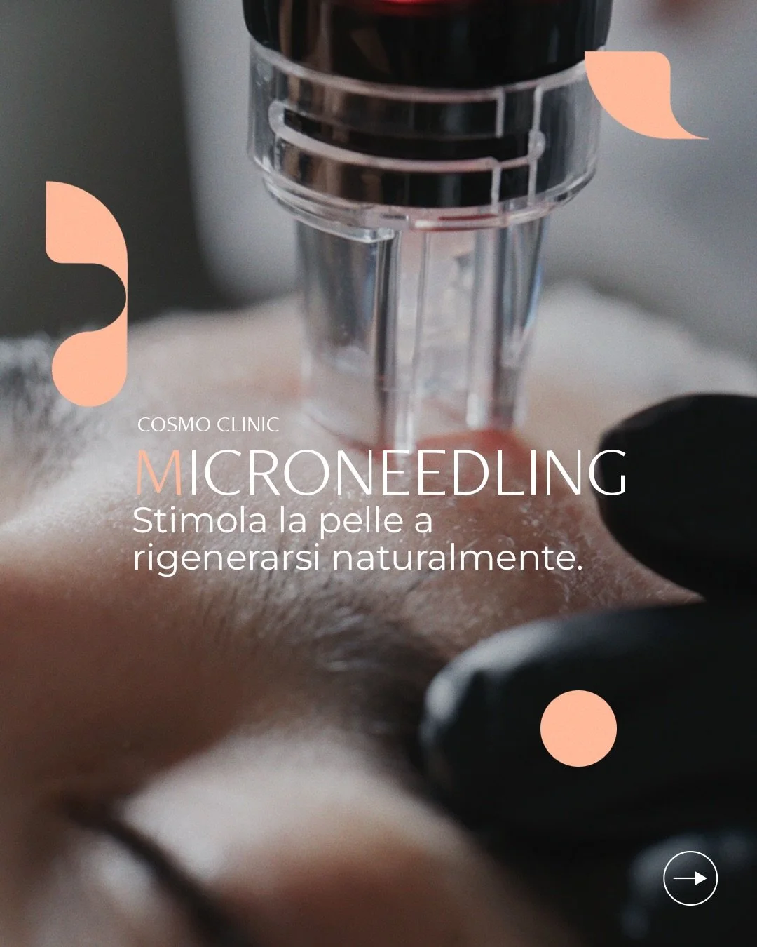 La pelle sa come rigenerarsi. Noi lo amplifichiamo.✨

Micro-needling: il trattamento che attiva i processi naturali di riparazione per una pelle pi&ugrave; compatta, luminosa, uniforme.

Scorri per scoprire come funziona. ➡️

📍 Milano &ndash; Verona