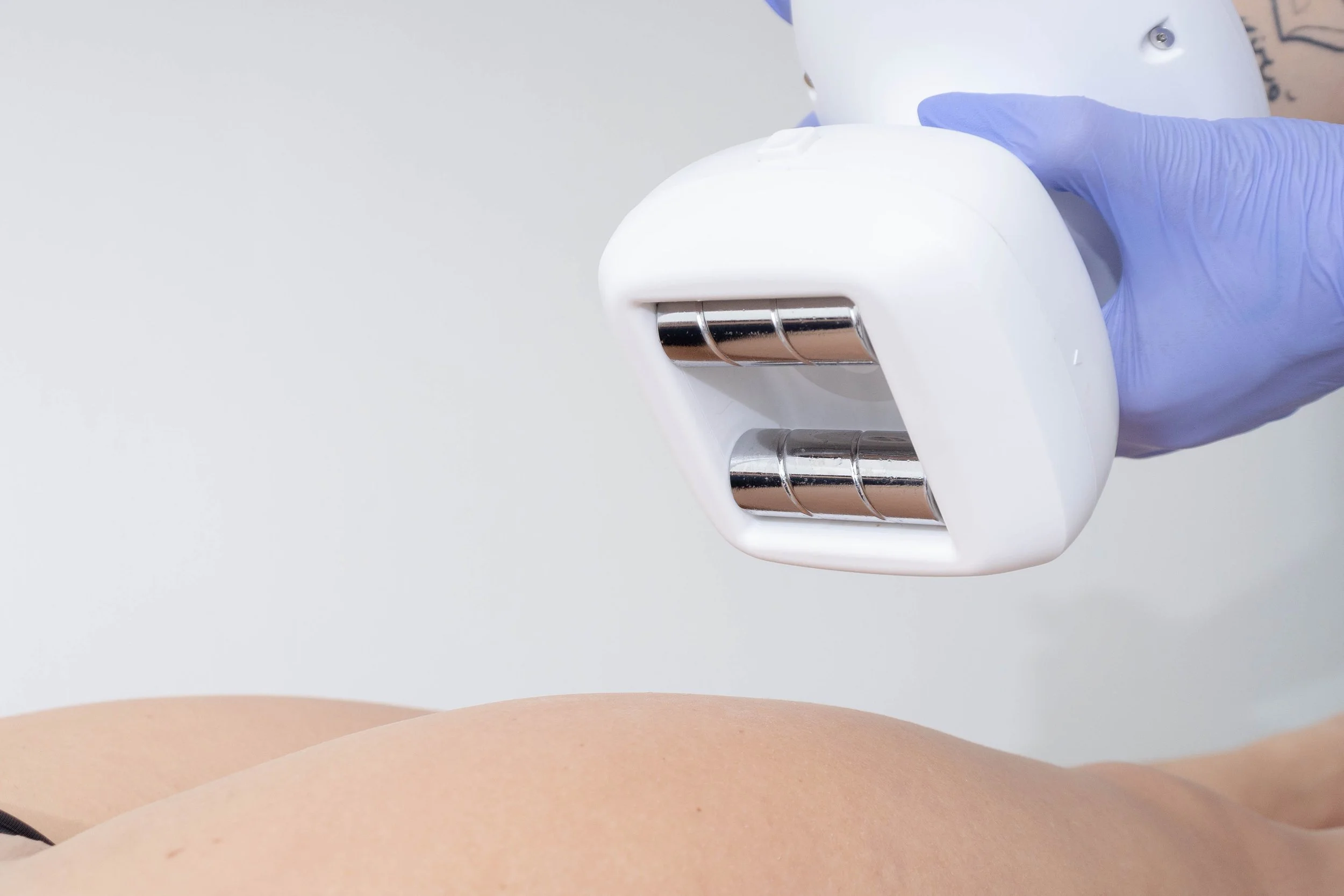 V Shape Platinum – Rimodellamento