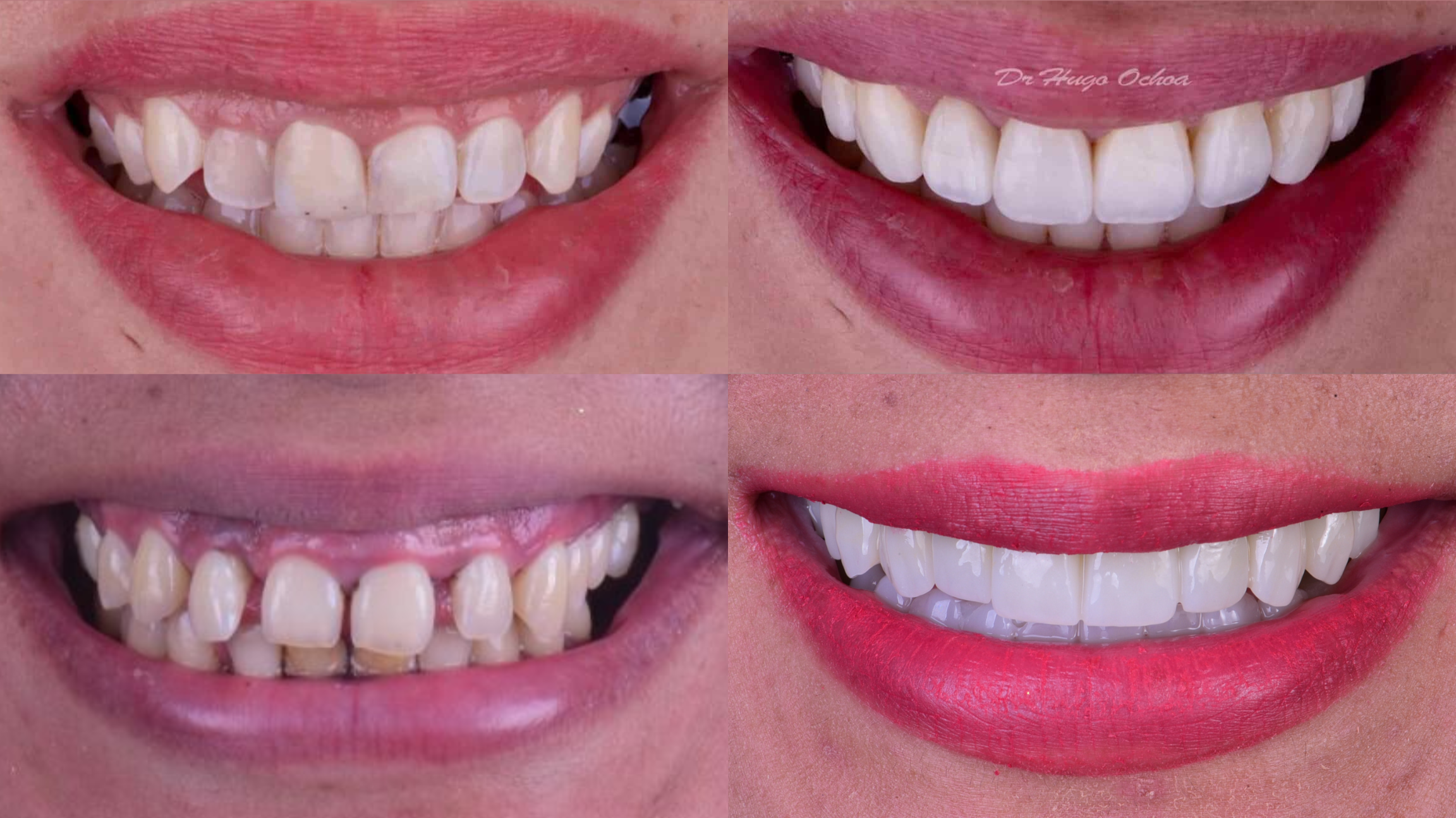 Antes y después de tratamientos dentales, mostrando mejora en la blancura y alineación de los dientes.