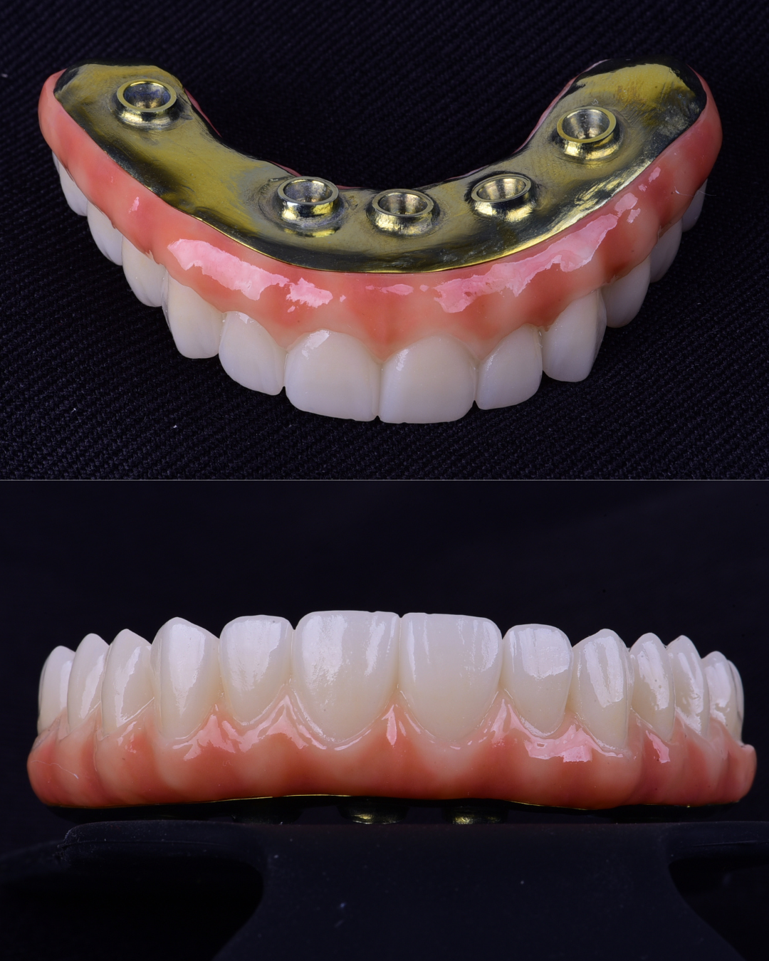 Prótesis dental superior con implantes y maqueta de dentadura inferior vista lateral y superior.