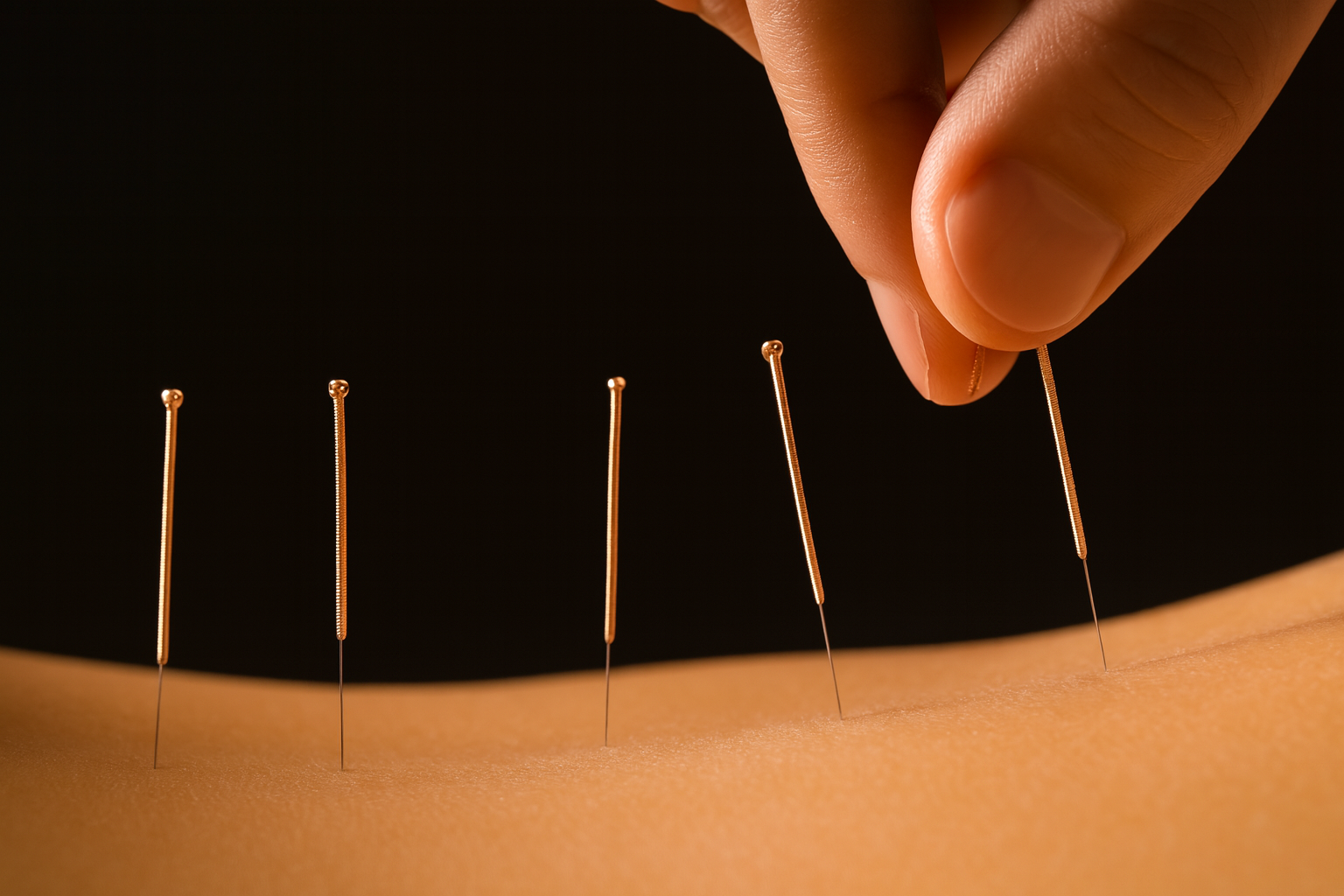 Close-up of a person's hand inserting a fine acupuncture needle into a person's skin, with three other needles already in place on the skin.