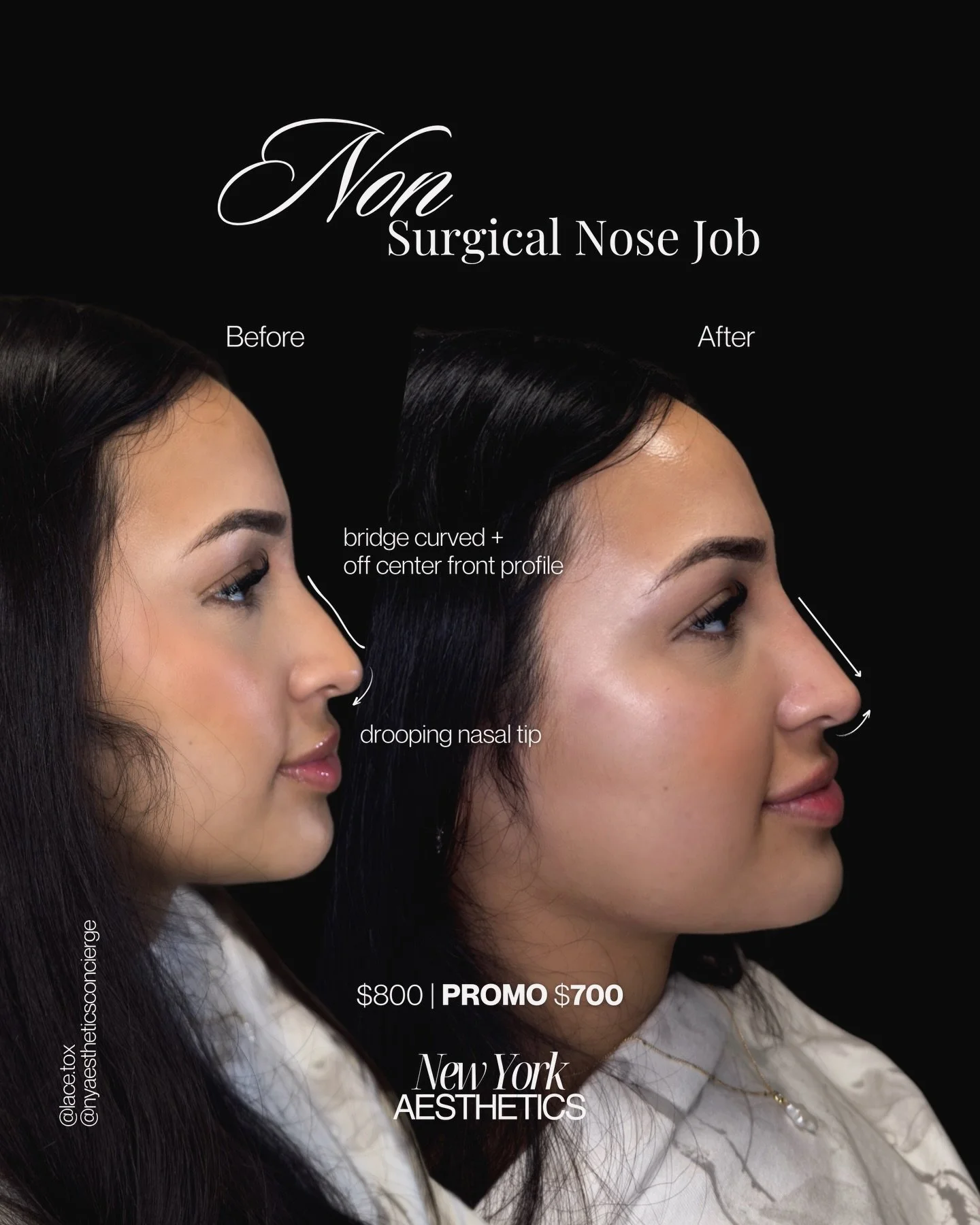 non-surgical nose job in NYC &mdash; no surgery, no downtime, real results 👃🏼✨

Liquid rhinoplasty uses filler to smooth your bridge, lift your tip + correct asymmetry &mdash; all in one appointment. Botox at the base keeps your tip lifted even whe