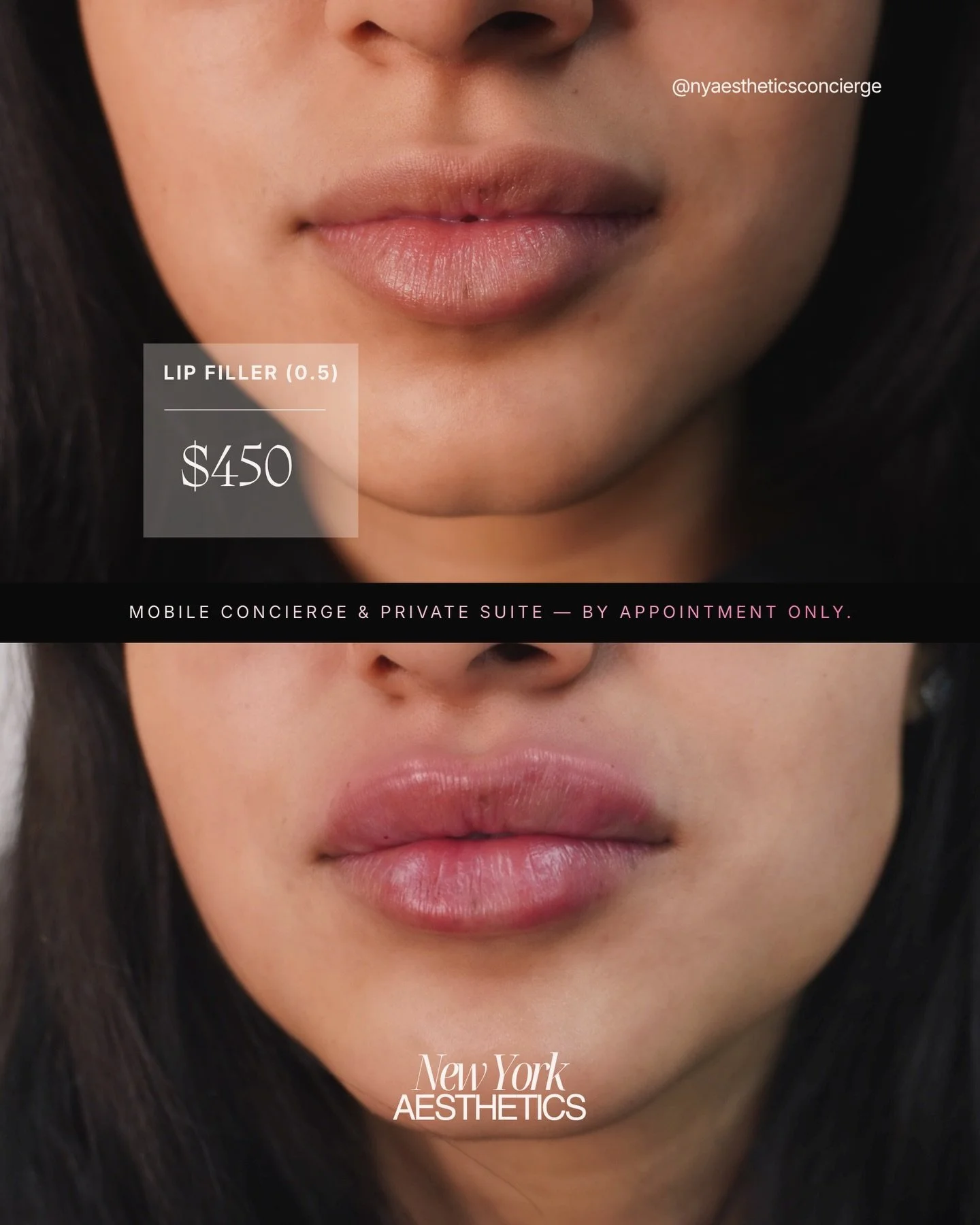 this is what 0.5ml looks like on the right injector. 👄

not overfilled. not obvious. just better.

lip filler starting at $450 &mdash; mobile concierge or private suite, by appointment only.
we come to you, or you come to us. either way, you leave l