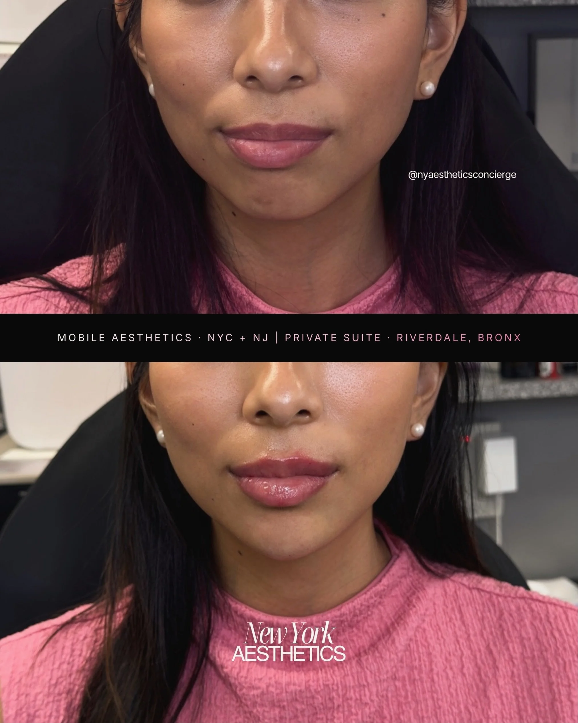 Lip Filler + Chin Filler. This is what facial balance actually looks like.

Most people focus on the lips alone but the chin is what gives the lips somewhere to land. When the chin is weak or recessed, even the most beautiful lip filler can look out 