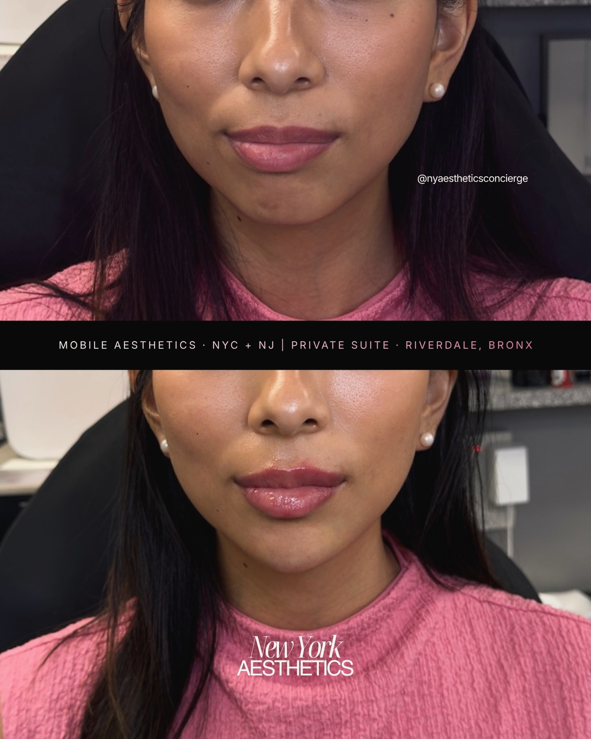 Lip Filler + Chin Filler. This is what facial balance actually looks like.

Most people focus on the lips alone but the chin is what gives the lips somewhere to land. When the chin is weak or recessed, even the most beautiful lip filler can look out 