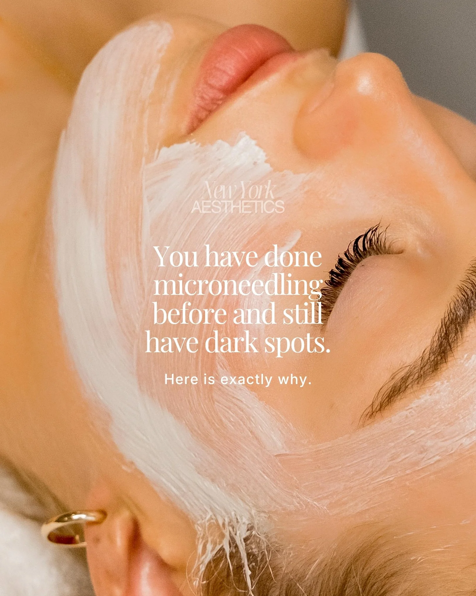 Microneedling without a prescription prep creates micro-channels in your skin and leaves them with nothing powerful enough to work through them. You get surface-level results that fade. The pigmentation comes back. You wonder if the treatment even wo
