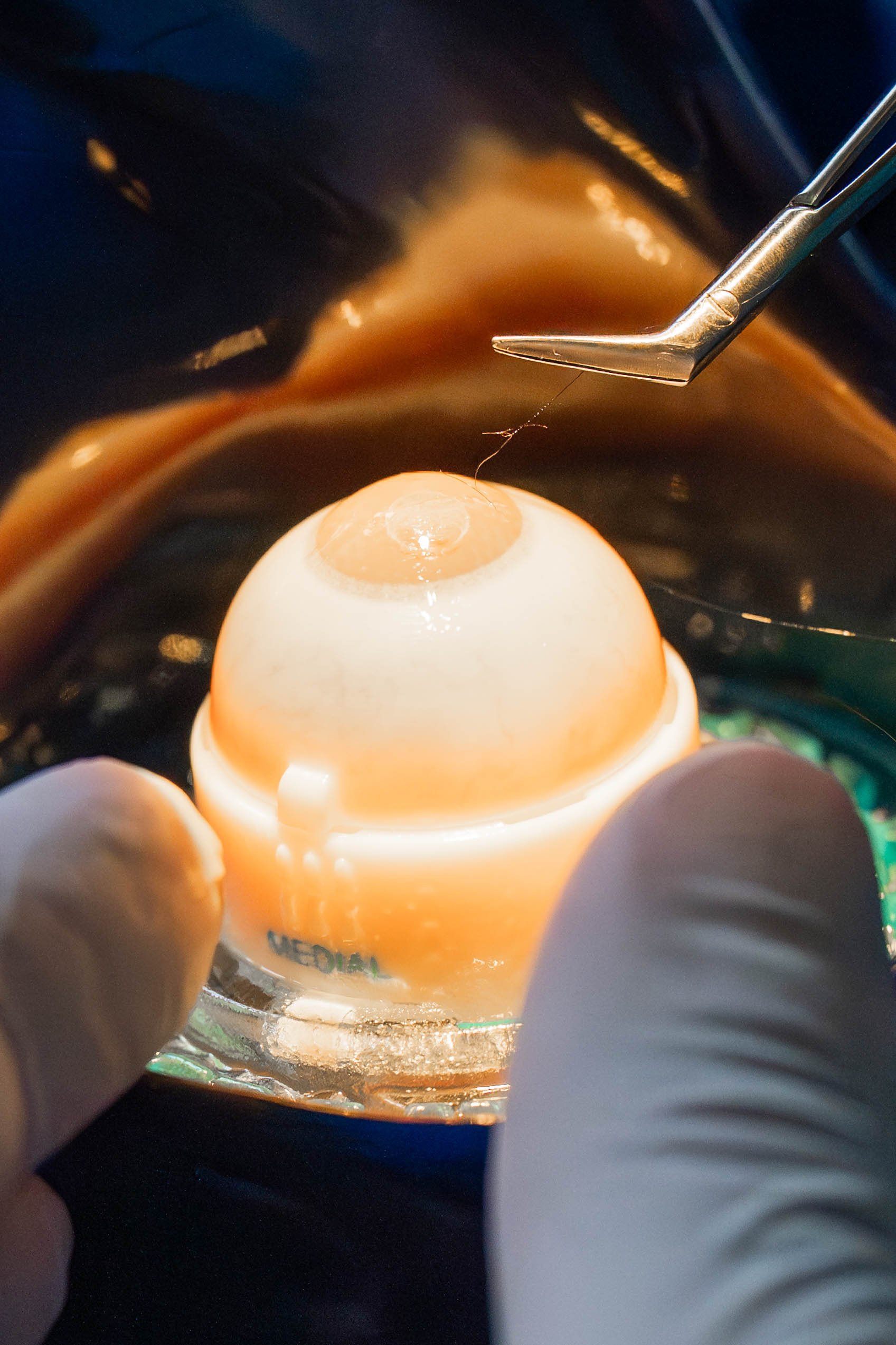 The SeThe Second Lid & Keratoplastic SUMMIT Tirol 2025