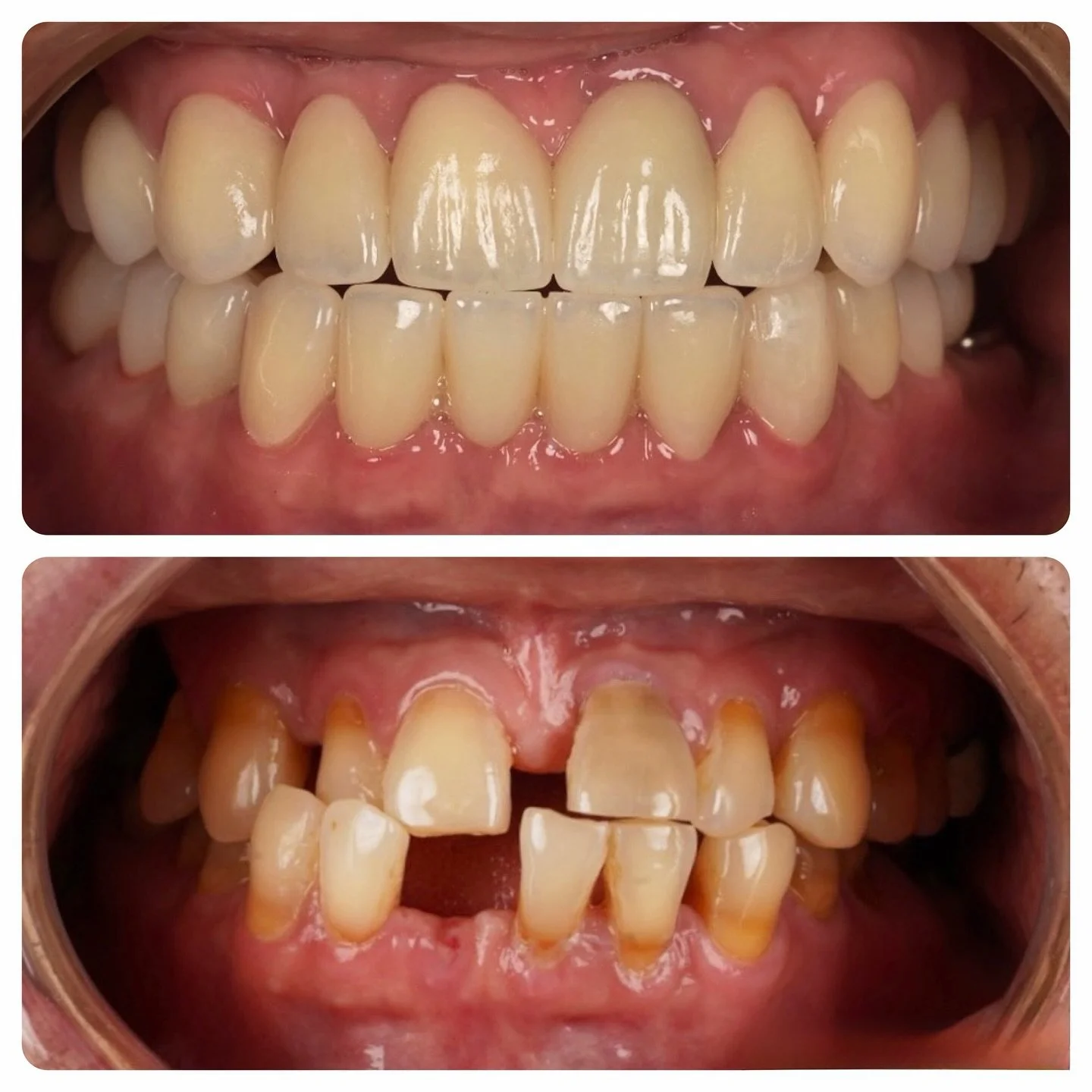 如果不說，光看重建後的樣子，你絕對不會相信這是一位 70+ 歲患者的牙齒。
為什麼能看起來這麼年輕自然？因為我們掌握了一個常被忽略的秘密武器：「牙齦高度」。
美學的底蘊，有太多容易被錯過的眉角。「懂細節」，不是光靠顯微鏡修牙齒就能說自己懂。真正的功力，在於將牙齒型態與牙齦邊緣的美感完美串連。
我們的美學哲學很簡單：不盲目追求刻意做舊的「戰損版」超仿真牙。我們的目標，是實實在在地協助患者找回那失落的咬合功能，並將那份遲來的自信笑容，完美地還給他們。
當咬合穩定了，笑容才經得起重新檢視。一個好看的笑