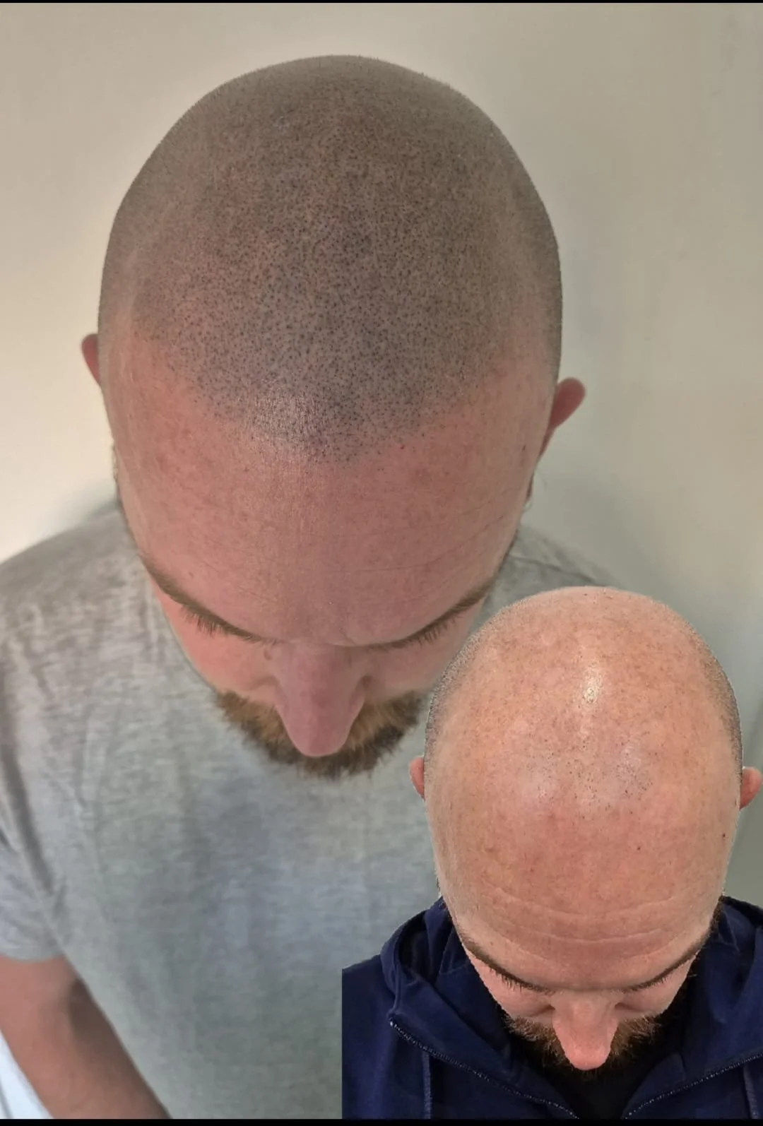 Comparison of two men's shaved heads, one with a full buzz cut and the other with a shaved head facing downward in a close-up