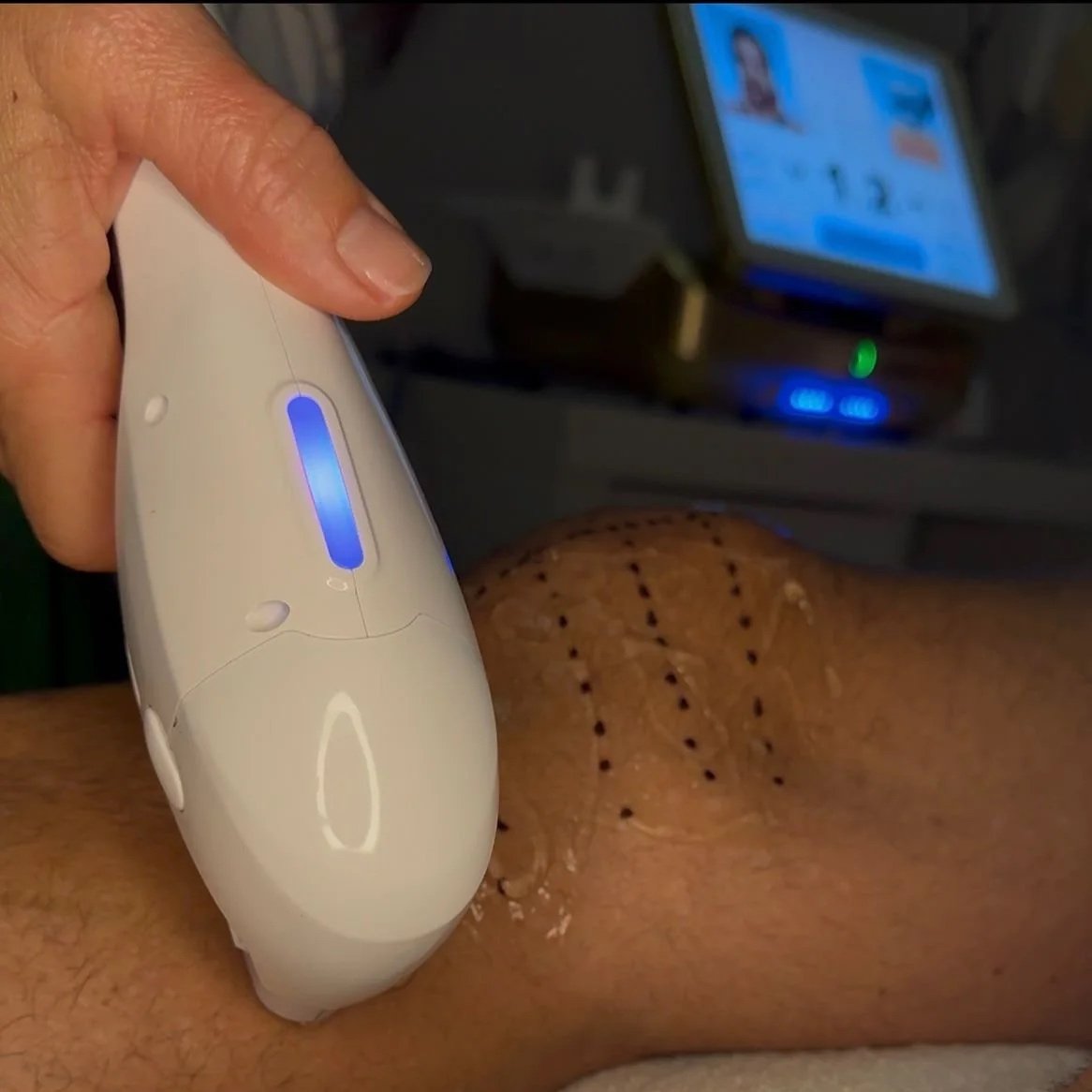 Paciente sometido a un procedimiento con un dispositivo láser o de luz en la pierna, en una clínica o consultorio médico.