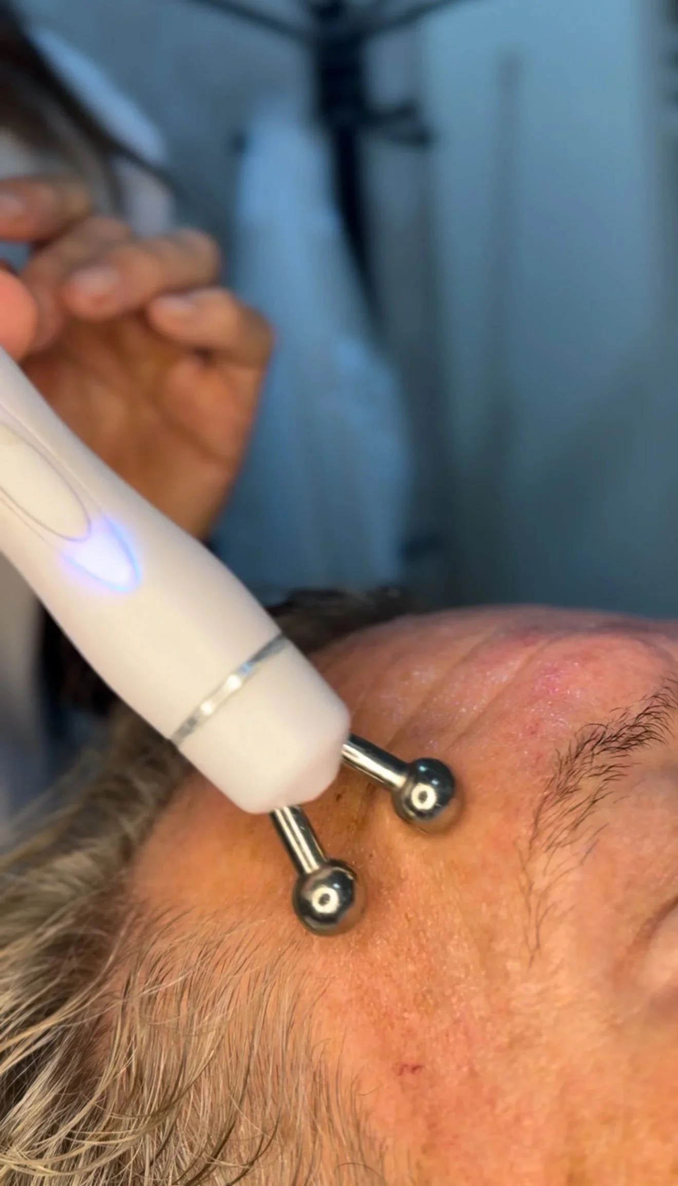 Procedimiento dermatológico con un aparato de terapia de radiofrecuencia en la frente de una persona.