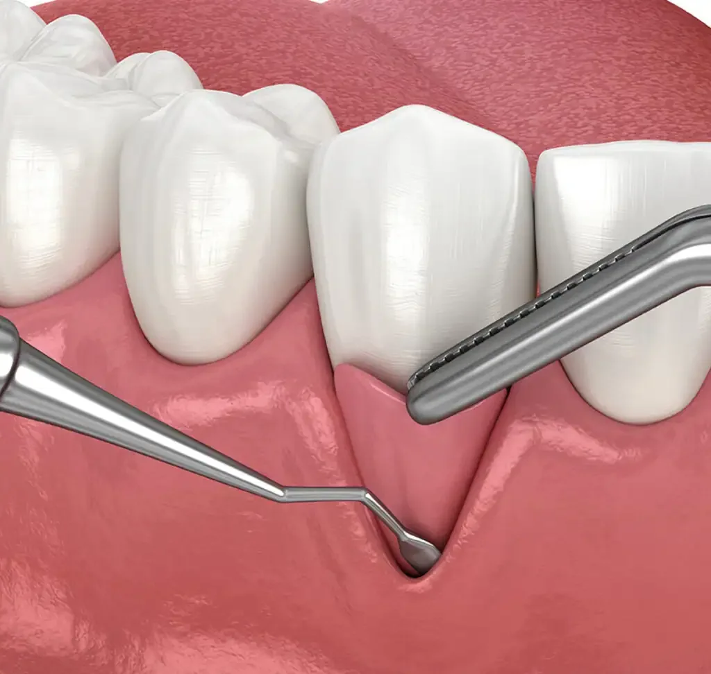 A dental procedure involving a tooth extraction, with dental tools working on a patient’s gum involving several molars and surrounding tissue.