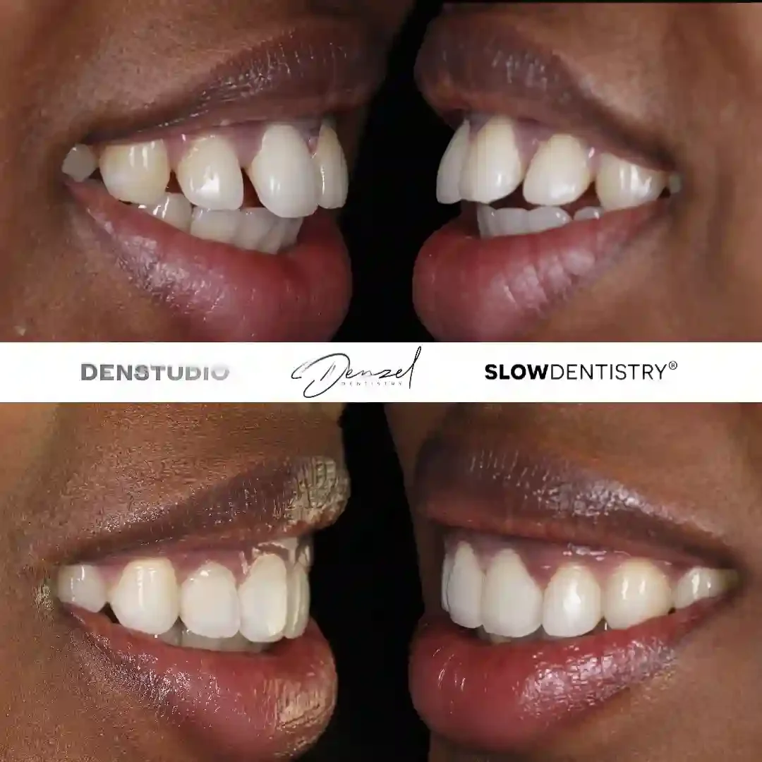Invisalign London