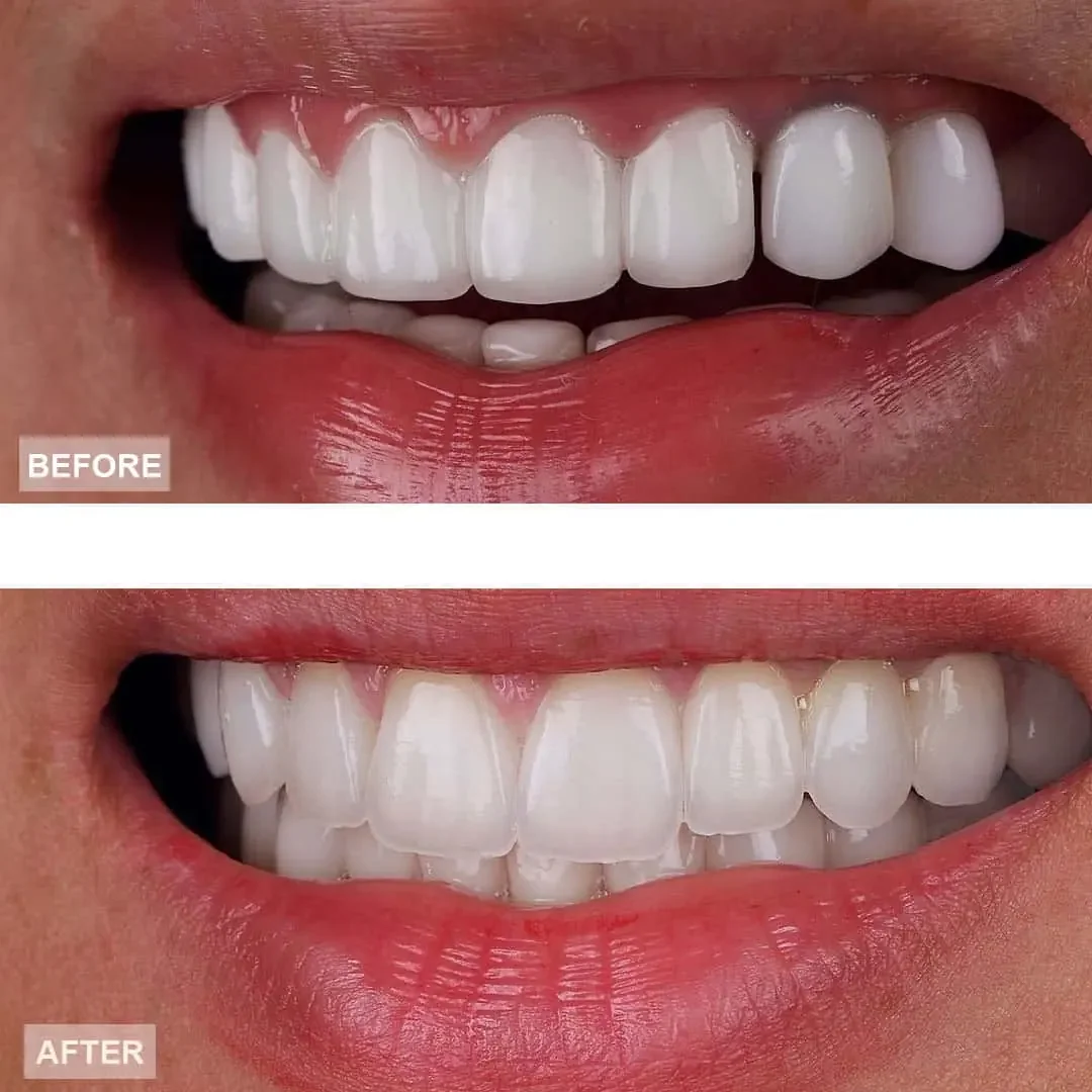 Close-up of a person's mouth showing a before and after comparison of teeth, with the after image showing whiter, straighter teeth.