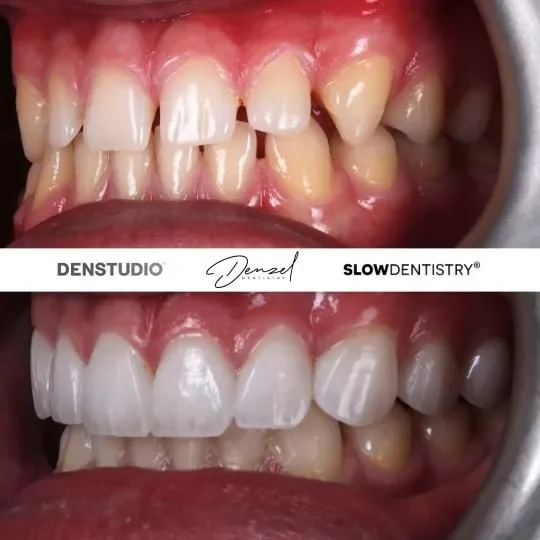 Veneers and bonding - dentist london