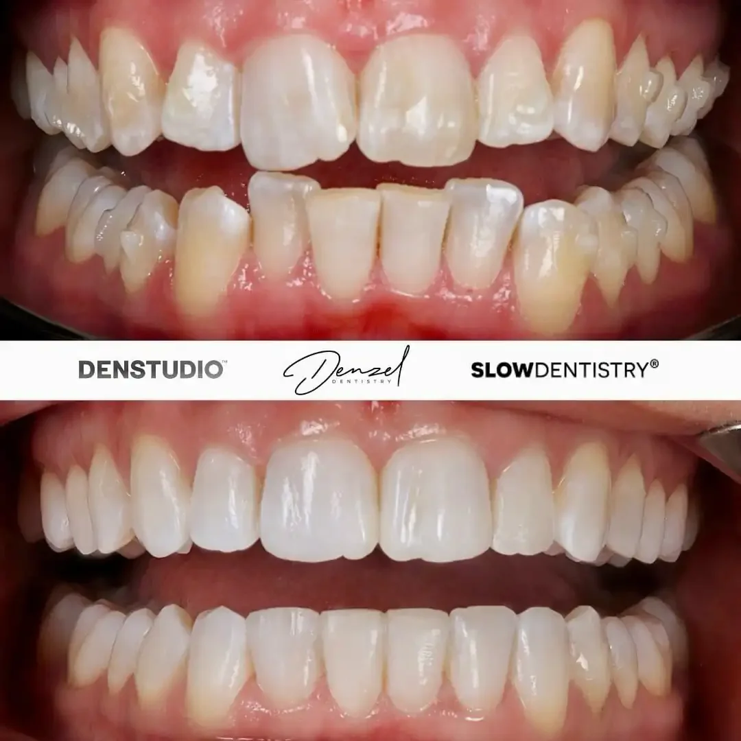 Comparison of teeth before and after dental treatment showing improved alignment and whitening.