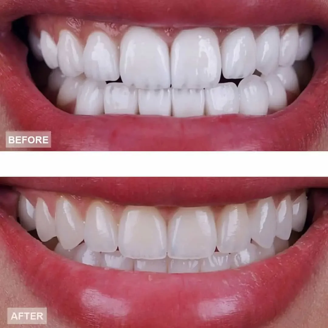 Close-up of a person's smiling mouth showing before and after whitening dental treatment; the after image depicts brighter, whiter teeth.