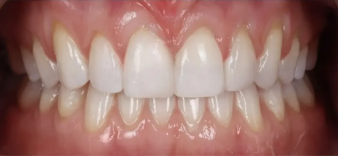 Close-up of a person's teeth showing a well-aligned, white smile.