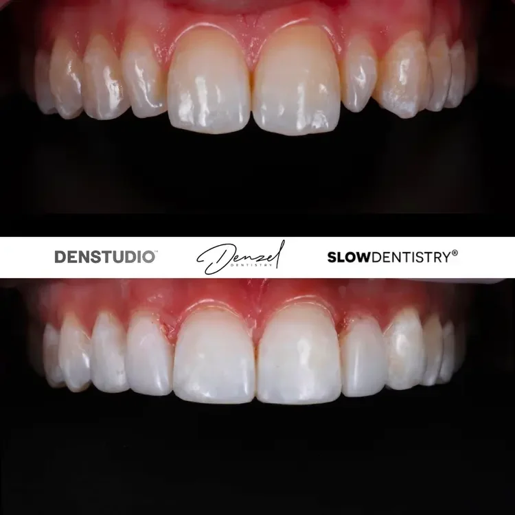 Cosmetic bonding treatment