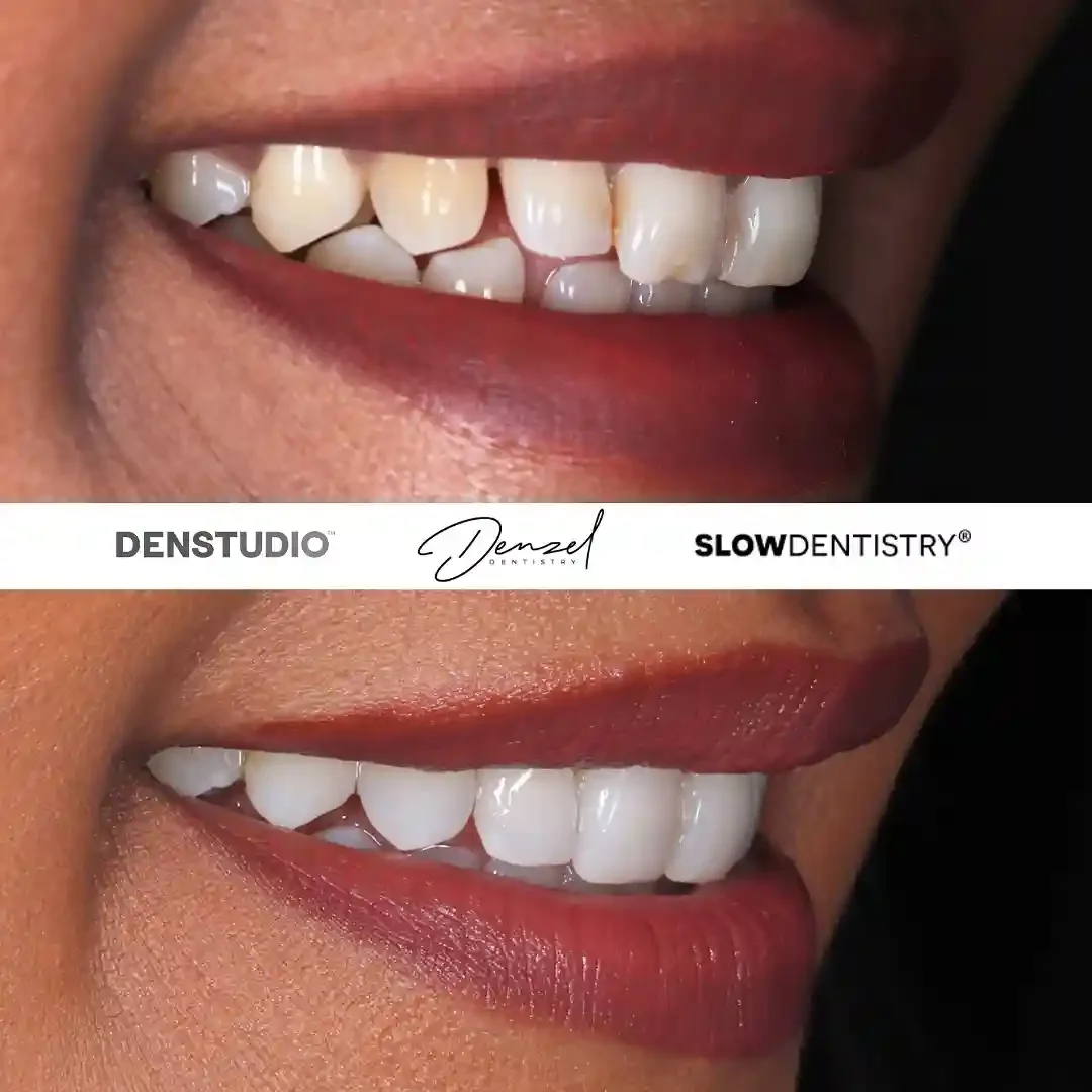Composite Bonding London | Dentstudio