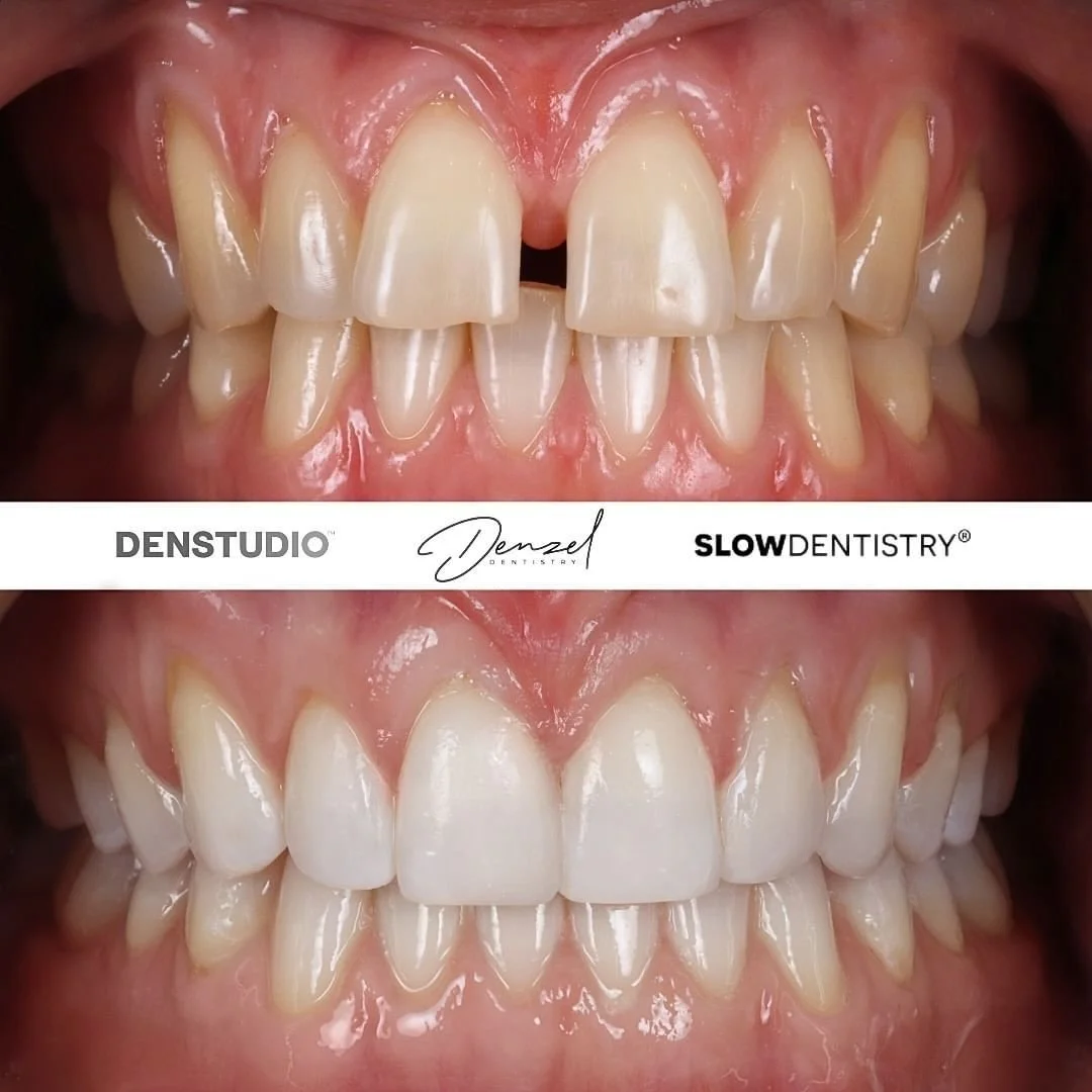 Comparison of teeth before and after dental whitening treatment, showing improved brightness and appearance.