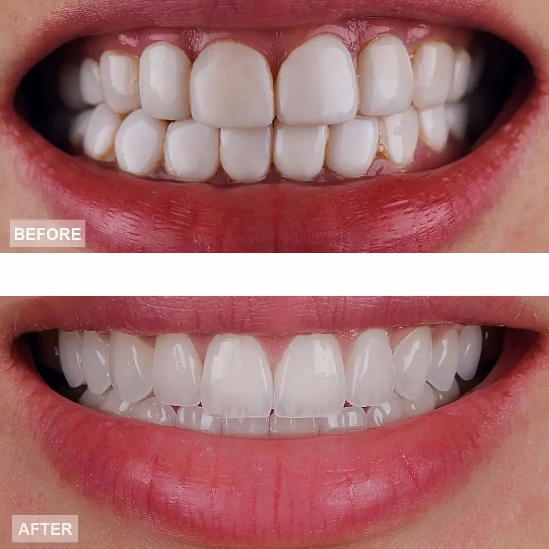 Close-up of a person's smile showing teeth before and after teeth whitening.