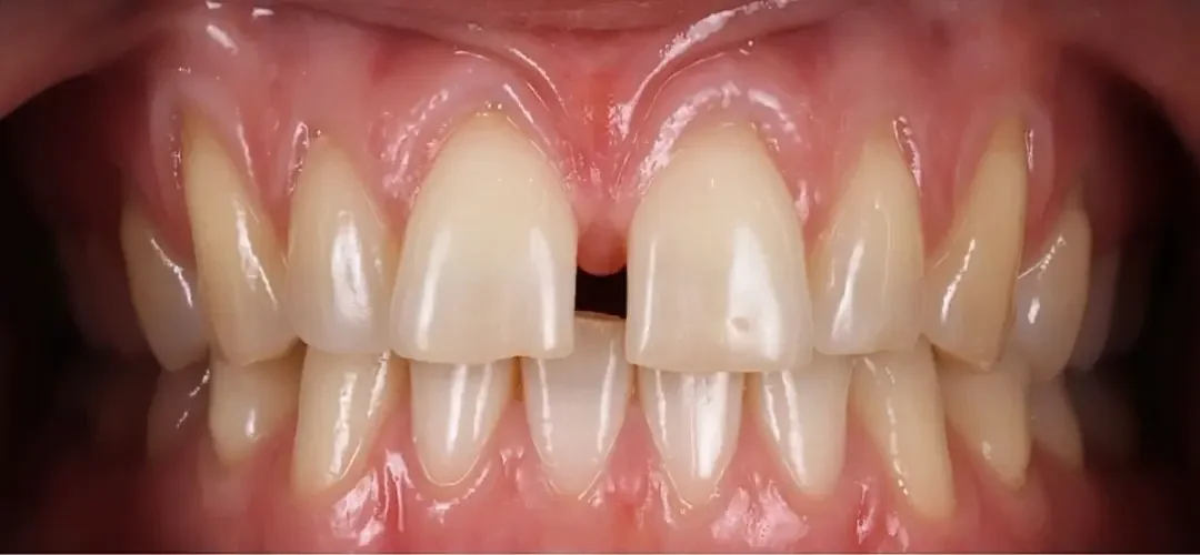 Close-up of human teeth showing misalignment and gaps.
