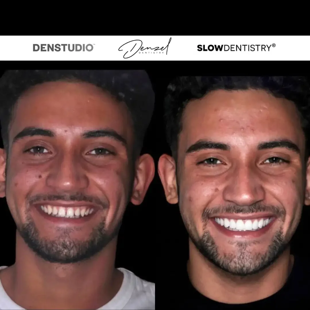 Harley Street Dentist London veneers