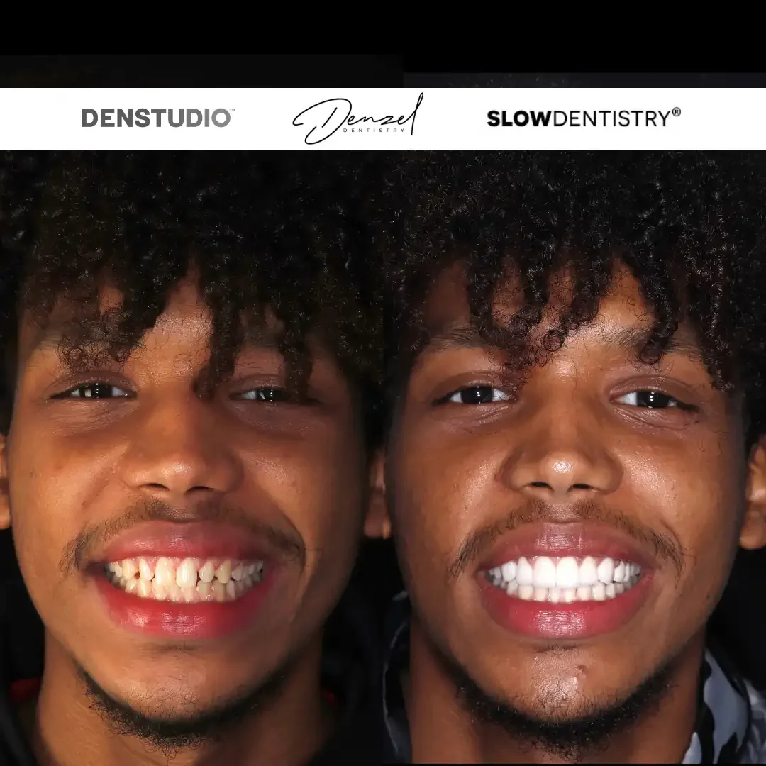 Side-by-side comparison of a young man before and after dental cosmetic treatment, showing significant improvement in teeth whiteness and alignment.
