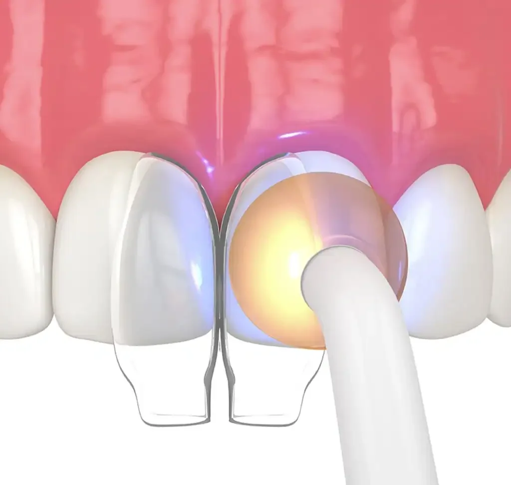 A close-up digital illustration of a dental procedure with a dental curing light shining on a tooth's filling.